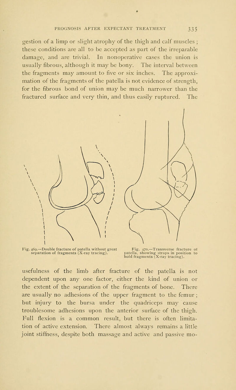 PROGNOSIS AFTER EXPECTANT TREATMENT -5 ■*> r* 333 gestion of a limp or slight atrophy of the thigh and calf muscles ; these conditions are all to be accepted as part of the irreparable damage, and are trivial. In nonoperative cases the union is usually fibrous, although it may be bony. The interval between the fragments may amount to five or six inches. The approxi- mation of the fragments of the patella is not evidence of strength, for the fibrous bond of union may be much narrower than the fractured surface and very thin, and thus easily ruptured. The Fig. 469.—Double fracture of patella without great Fig. 470.—Transverse fracture of separation of fragments (X-ray tracing). patella, showing straps in position to hold fragments (X-ray tracing). usefulness of the limb after fracture of the patella is not dependent upon any one factor, either the kind of union or the extent of the separation of the fragments of bone. There are usually no adhesions of the upper fragment to the femur ; but injury to the bursa under the quadriceps may cause troublesome adhesions upon the anterior surface of the thigh. Full flexion is a common result, but there is often limita- tion of active extension. There almost always remains a little joint stiffness, despite both massage and active and passive mo-