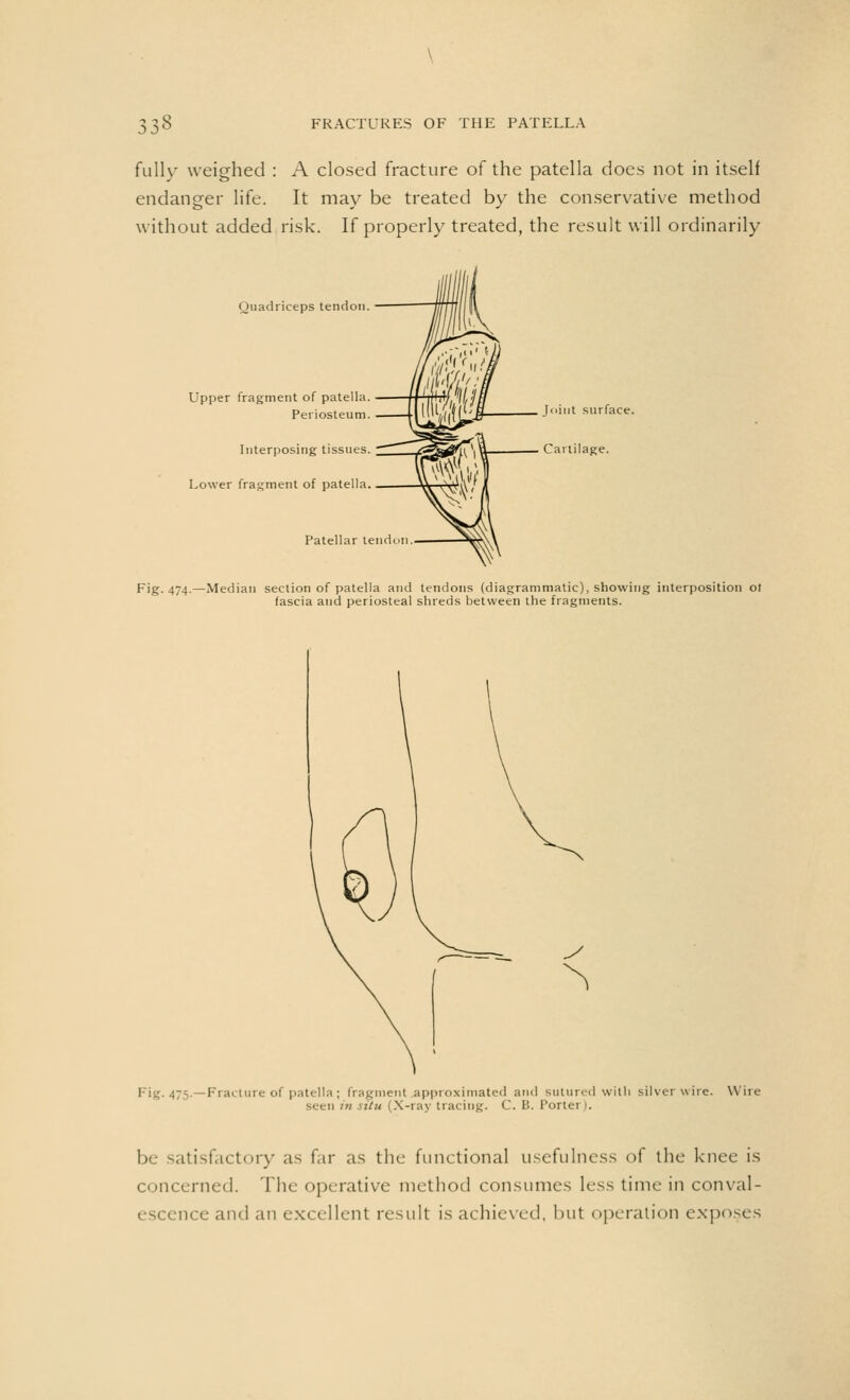 fully weighed : A closed fracture of the patella does not in itself endanger life. It may be treated by the conservative method without added risk. If properly treated, the result will ordinarily Quadriceps tendon. Upper fragment of patella. Periosteum. Interposing tissues. Lower fragment of patella. Patellar tend Joint surface. — Cartilage. Fig. 474.—Median section of patella and tendons (diagrammatic), showing interposition ot fascia and periosteal shreds between the fragments. Fig.475.—Fracture of patella; fragment approximated and sutured with silver wire. Wire seen m .\itu (X-ray tracing. C. B. Portei I. be satisfactory as far as the functional usefulness of the knee is concerned. The operative method consumes less time in conval- escence and an excellent result is achieved, but operation exposes