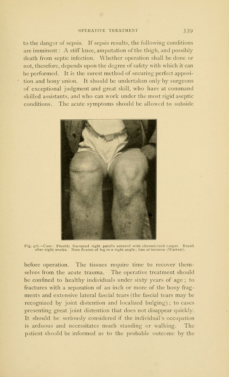 to the danger of sepsis. If sepsis results, the following conditions are imminent: A stiff knee, amputation of the thigh, and possibly death from septic infection. Whether operation shall be done or not, therefore, depends upon the degree of safety with which it can be performed. It is the surest method of securing perfect apposi- tion and bony union. It should be undertaken only by surgeons of exceptional judgment and great skill, who have at command skilled assistants, and who can work under the most rigid aseptic conditions. The acute symptoms should be allowed to subside Fig. 476.—Case: Freshly fractured right patella sutured with chromieized catgut. Result after eight weeks. Note flexion of leg to a right angle ; line of incision (Warren). before operation. The tissues require time to recover them- selves from the acute trauma. The operative treatment should be confined to healthy individuals under sixty years of age ; to fractures with a separation of an inch or more of the bony frag- ments and extensive lateral fascial tears (the fascial tears may be recognized by joint distention and localized bulging) ; to cases presenting great joint distention that does not disappear quickly. It should be seriously considered if the individual's occupation is arduous and necessitates much standing or walking. The patient should be informed as to the probable outcome by the