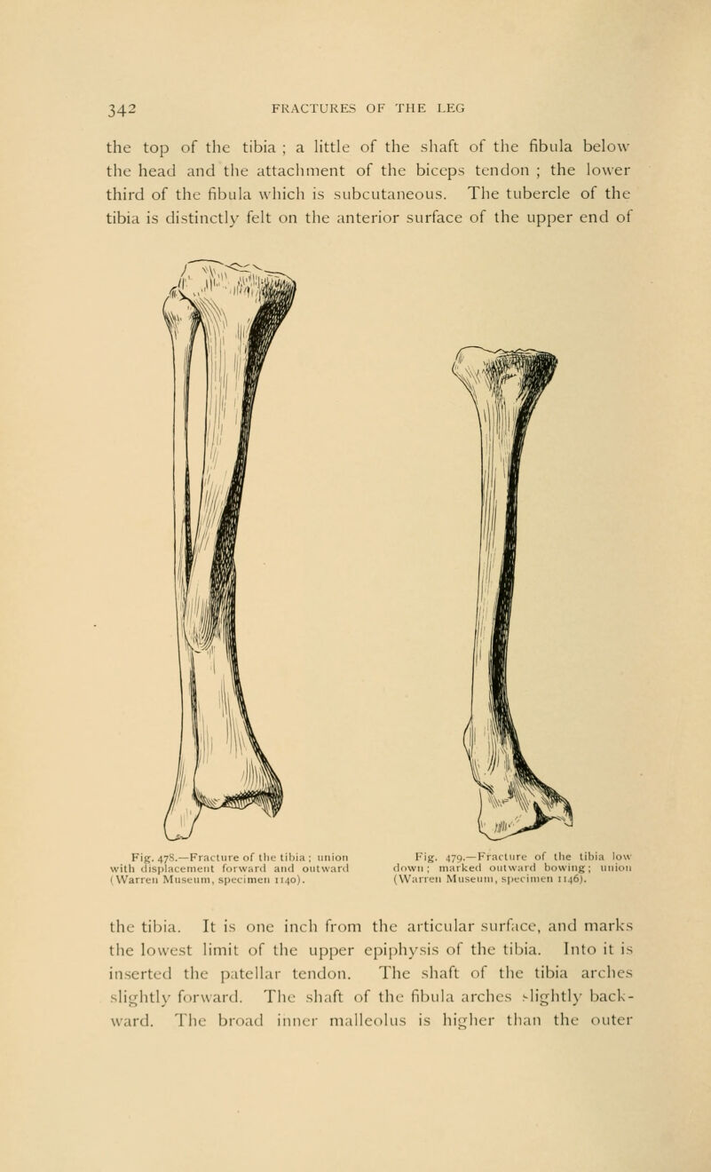 the top of the tibia ; a little of the shaft of the fibula below the head and the attachment of the biceps tendon ; the lower third of the fibula which is subcutaneous. The tubercle of the tibia is distinctly felt on the anterior surface of the upper end of / i^Sv Fig. 478.—Fracture of the tibia ; union with displacement forward and outward (Warren Museum, specimen 1140). Fig. 479.—Fracture of the tibia low down; marked outward bowing; union (Warren Museum, specimen 1146). the tibia. It is one inch from the articular surface, and marks the lowest limit of the upper epiphysis of the tibia. Into it is inserted the patellar tendon. The shaft of the tibia arches slightly forward. The shaft of the fibula arches slightly back- ward. The broad inner malleolus is higher than the outer