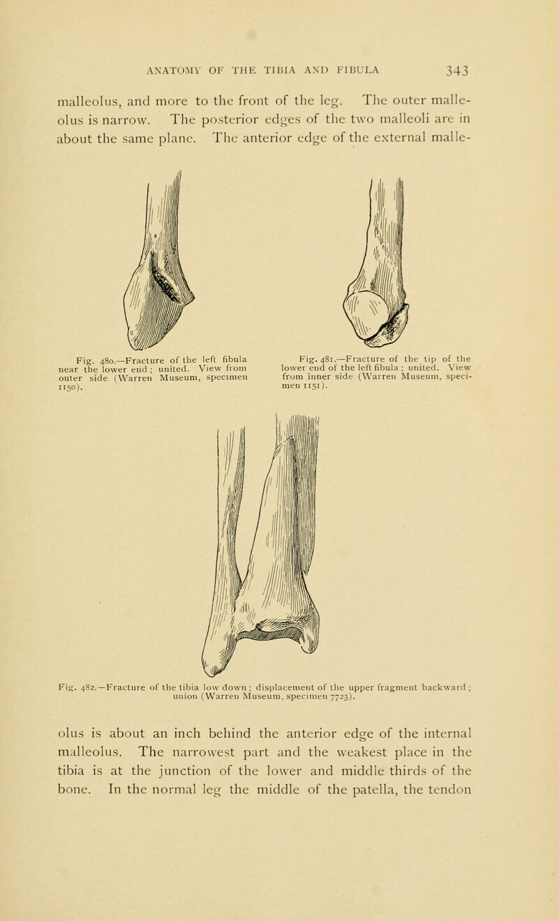 malleolus, and more to the front of the leg. The outer malle- olus is narrow. The posterior edges of the two malleoli are in about the same plane. The anterior edge of the external malle- Fig. 480.—Fracture of the left fibula near the lower end ; united. View from outer side (Warren Museum, specimen 1150). Fig. 481.—Fracture of the tip of the lower end of the left fibula ; united. View from inner side (Warren Museum, speci- men 1151). Fig. 482.—Fracture of the tibia low down ; displacement of the upper fragment backward ; union (Warren Museum, specimen 7723). olus is about an inch behind the anterior edge of the internal malleolus. The narrowest part and the weakest place in the tibia is at the junction of the lower and middle thirds of the bone. In the normal leg the middle of the patella, the tendon