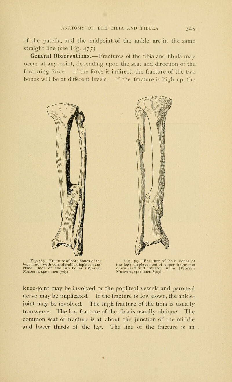 34! of the patella, and the midpoint of the ankle are in the same straight line (see Fig, 477). General Observations.—Fractures of the tibia and fibula may occur at any point, depending upon the seat and direction of the fracturing force. If the force is indirect, the fracture of the two bones will be at different levels. If the fracture is high up, the Fig. 484.—Fracture of both bones of the leg; union with considerable displacement; cross union of the two bones (Warren Museum, specimen 5265). Fig. 485.—Fracture of both bones ot the leg; displacement of upper fragments downward and inward ; union (Warren Museum, specimen S303). knee-joint may be involved or the popliteal vessels and peroneal nerve may be implicated. If the fracture is low down, the ankle- joint may be involved. The high fracture of the tibia is usually transverse. The low fracture of the tibia is usually oblique. The common seat of fracture is at about the junction of the middle and lower thirds of the lee. The line of the fracture is an