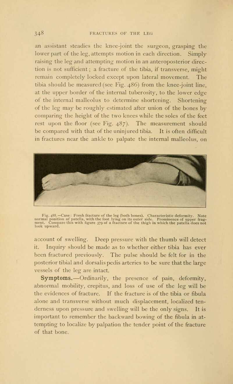 an assistant steadies the knee-joint the surgeon, grasping the lower part of the leg, attempts motion in each direction. Simply raising the leg and attempting motion in an anteroposterior direc- tion is not sufficient; a fracture of the tibia, if transverse, might remain completely locked except upon lateral movement. The tibia should be measured (see Fig. 486) from the knee-joint line, at the upper border of the internal tuberosity, to the lower edge of the internal malleolus to determine shortening. Shortening of the leg may be roughly estimated after union of the bones by comparing the height of the two knees while the soles of the feet rest upon the floor (see Fig. 487). The measurement should be compared with that of the uninjured tibia. It is often difficult in fractures near the ankle to palpate the internal malleolus, on Fig. 488.—Case : Fresh fracture of the leg (hoth bones). Characteristic deformity. Note normal position of patella, with the foot lying on its outer side. Prominence of upper frag- ment. Compare this with figure 379 of a fracture of the thigh in which the patella does not look upward. account of swelling. Deep pressure with the thumb will detect it. Inquiry should be made as to whether either tibia has ever been fractured previously. The pulse should be felt for in the posterior tibial and dorsalis pedis arteries to be sure that the large vessels of the leg are intact. Symptoms.—Ordinarily, the presence of pain, deformity, abnormal mobility, crepitus, and loss of use of the leg will be the evidences of fracture. If the fracture is of the tibia or fibula alone and transverse without much displacement, localized ten- derness upon pressure and swelling will be the only signs. It is important to remember the backward bowing of the fibula in at- tempting to localize by palpation the tender point of the fracture of that bone.