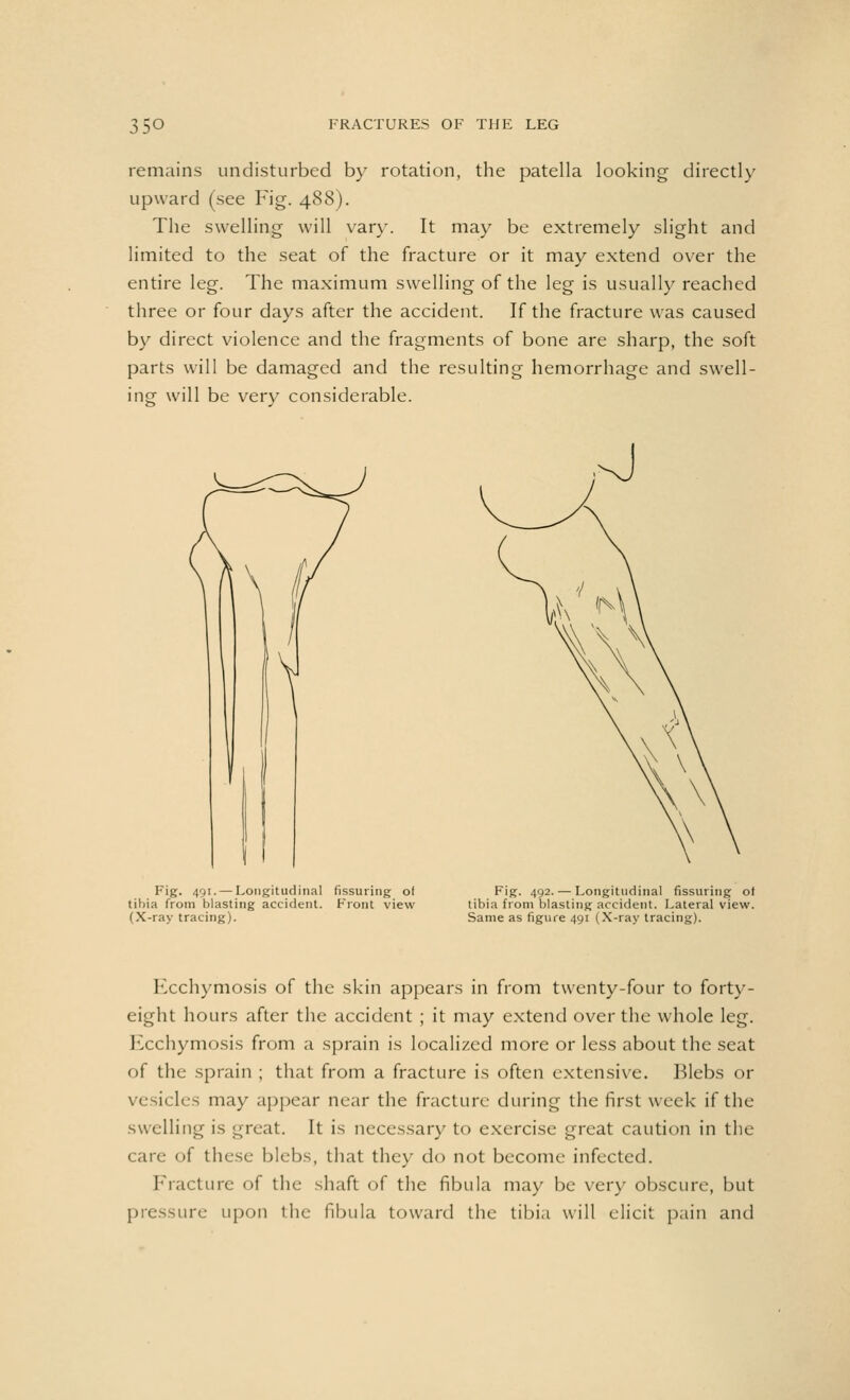 remains undisturbed by rotation, the patella looking directly upward (see Fig. 488). The swelling will vary. It may be extremely slight and limited to the seat of the fracture or it may extend over the entire leg. The maximum swelling of the leg is usually reached three or four days after the accident. If the fracture was caused by direct violence and the fragments of bone are sharp, the soft parts will be damaged and the resulting hemorrhage and swell- ing will be very considerable. Fig. 491. — Longitudinal Assuring of tibia from blasting accident. Front view (X-ray tracing). Fig. 492. — Longitudinal Assuring ol tibia from blasting accident. Lateral view. Same as figure 491 (X-ray tracing). Ecchymosis of the skin appears in from twenty-four to forty- eight hours after the accident ; it may extend over the whole leg. Ecchymosis from a sprain is localized more or less about the seat of the sprain ; that from a fracture is often extensive. Blebs or vesicles may appear near the fracture during the first week if the swelling is great. It is necessary to exercise great caution in the care of these blebs, that they do not become infected. Fracture of the shaft of the fibula may be very obscure, but pressure upon the fibula toward the tibia will elicit pain and