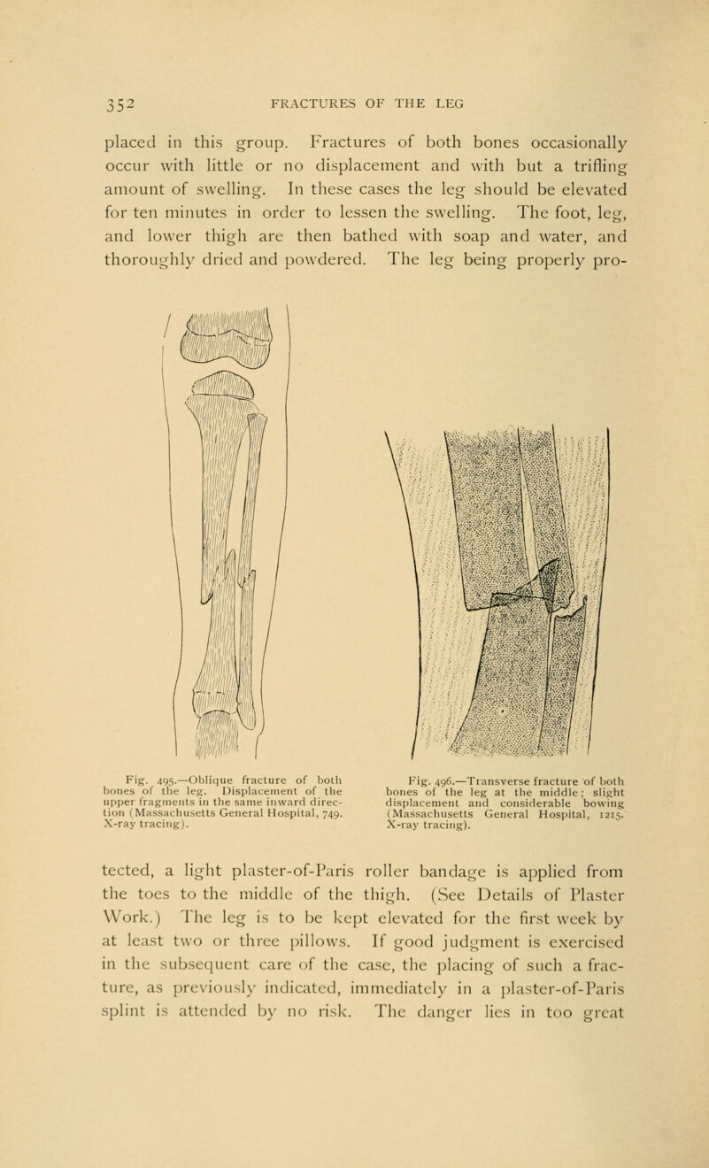 placed in this group. Fractures of both bones occasionally occur with little or no displacement and with but a trifling amount of swelling. In these cases the leg should be elevated for ten minutes in order to lessen the swelling. The foot, leg, and lower thigh are then bathed with soap and water, and thoroughly dried and powdered. The leg being properly pro- p's- 495-—Oblique fracture of both bones of the leg. Displacement of the upper fragments in the same inward direc- tion 1 Massachusetts General Hospital, 749. X-ray tracing). Fig. 496.—Transverse fracture of both bones of the leg at the middle; slight displacement and considerable bowing (Massachusetts General Hospital, 1215. X-ray tracing). tected, a light plaster-of-Paris roller bandage is applied from the toes to the middle of the thigh. (See Details of Plaster Work.) The leg is to be kept elevated for the first week by at least two or three pillows. If good judgment is exercised in the subsequent care of the case, the placing of such a frac- ture, as previously indicated, immediately in a plaster-of-Paris splint is attended by no risk. The danger lies in too great
