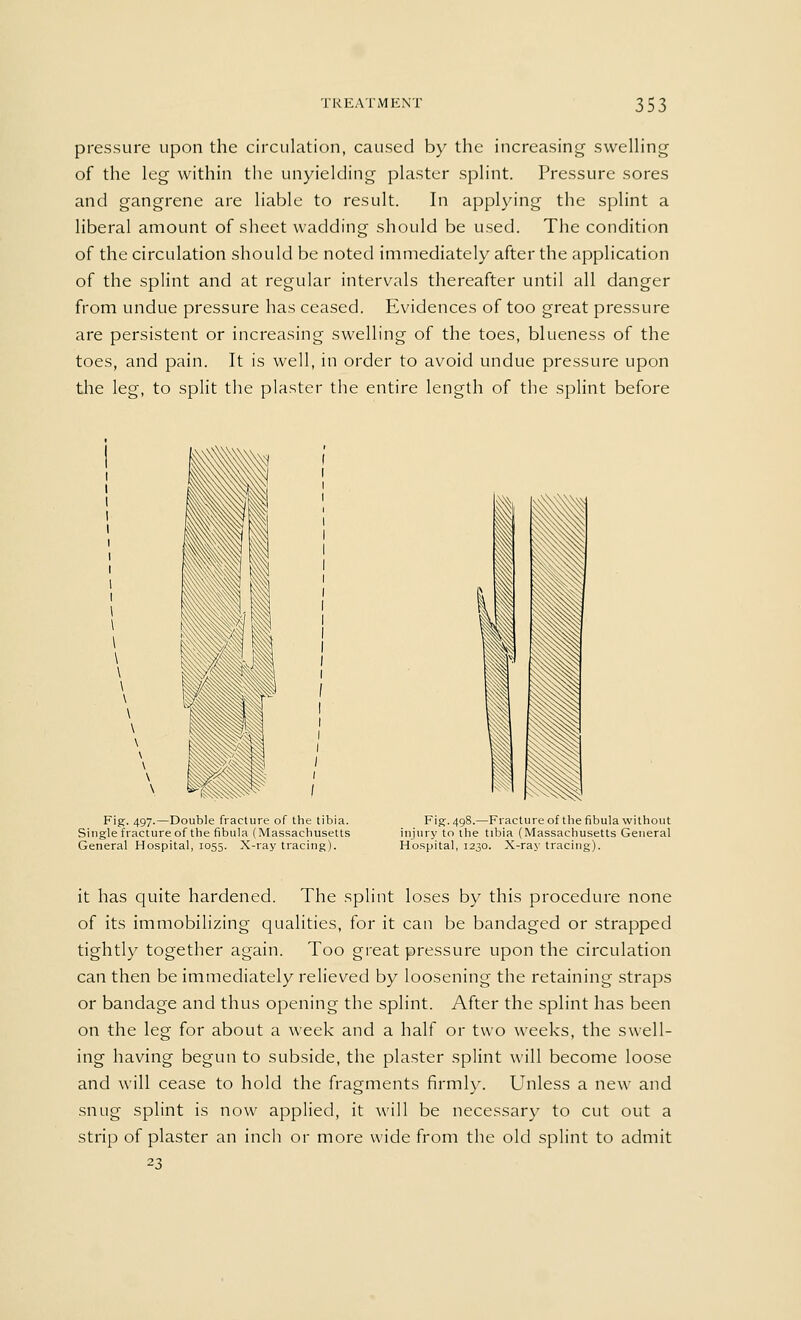 pressure upon the circulation, caused by the increasing swelling of the leg within the unyielding plaster splint. Pressure sores and gangrene are liable to result. In applying the splint a liberal amount of sheet wadding should be used. The condition of the circulation should be noted immediately after the application of the splint and at regular intervals thereafter until all danger from undue pressure has ceased. Evidences of too great pressure are persistent or increasing swelling of the toes, blueness of the toes, and pain. It is well, in order to avoid undue pressure upon the leg, to split the plaster the entire length of the splint before Fig:. 497-—Double fracture of the tibia. Single fracture of the fibula (Massachusetts General Hospital, 1055. X-ray tracing). Fig. 498.—Fracture of the fibula without injury to the tibia (Massachusetts General Hospital, 1230. X-ray tracing). it has quite hardened. The splint loses by this procedure none of its immobilizing qualities, for it can be bandaged or strapped tightly together again. Too great pressure upon the circulation can then be immediately relieved by loosening the retaining straps or bandage and thus opening the splint. After the splint has been on the leg for about a week and a half or two weeks, the swell- ing having begun to subside, the plaster splint will become loose and will cease to hold the fragments firmly. Unless a new and snug splint is now applied, it will be necessary to cut out a strip of plaster an inch or more wide from the old splint to admit