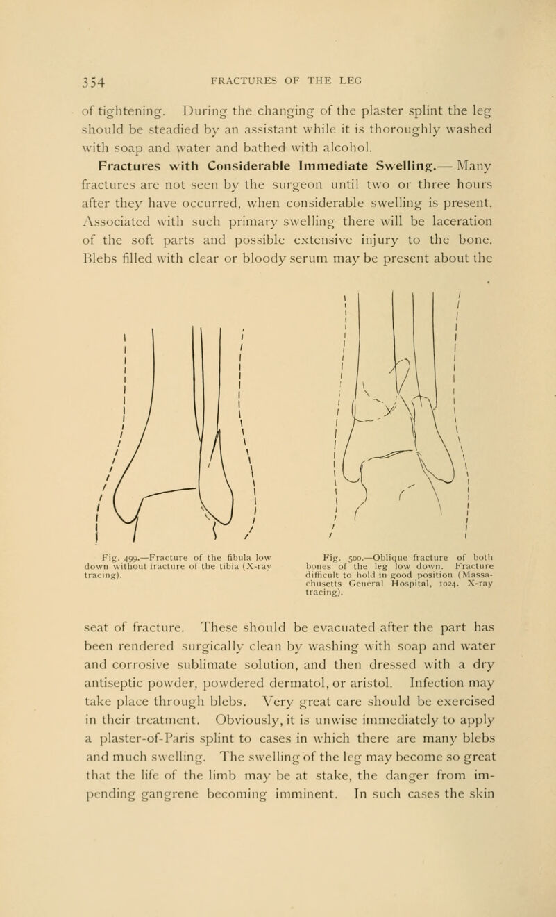of tightening. During the changing of the plaster splint the leg should be steadied by an assistant while it is thoroughly washed with soap and water and bathed with alcohol. Fractures with Considerable Immediate Swelling.— Many fractures are not seen by the surgeon until two or three hours after they have occurred, when considerable swelling is present. Associated with such primary swelling there will be laceration of the soft parts and possible extensive injury to the bone. Blebs filled with clear or bloody serum may be present about the Fig. 499.—Fracture of the fibula low down without fracture of the tibia (X-ray tracing). Fig. 500.—Oblique fracture of both bones of the leg low down. Fracture difficult to hold in good position (Massa- chusetts General Hospital, 1024. X-ray tracing). seat of fracture. These should be evacuated after the part has been rendered surgically clean by washing with soap and water and corrosive sublimate solution, and then dressed with a dry antiseptic powder, powdered dermatol.or aristol. Infection may take place through blebs. Very great care should be exercised in their treatment. Obviously, it is unwise immediately to apply a plaster-of-Paris splint to cases in which there are many blebs and much swelling. The swelling of the leg may become so great that the life of the limb may be at stake, the danger from im- pending gangrene becoming imminent. In such cases the skin