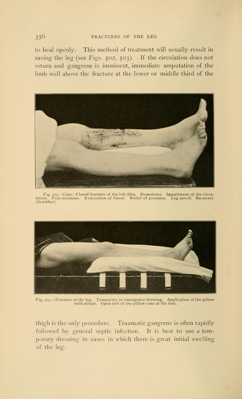 to heal openly. This method of treatment will usually result in saving the leg (see Figs. 502, 503). If the circulation does not return and gangrene is imminent, immediate amputation of the limb well above the fracture at the lower or middle third of the Fig. 503.—Case: Closed fracture of the left tibia. Hematoma. Impairment of the circu- lation. Free incisions. Evacuation of blood. Relief of pressure. Leg saved. Recovery (Scudder). A w4* !~ ___ | ^ Fig. 504. — Fracture of the leg. Temporary or emergency dressing. Application of the pillow with straps. Open end of the pillow-case at the foot. thigh is the only procedure. Traumatic gangrene is often rapidly followed by general septic infection. It is best to use a tem- porary dressing in cases in which there is great initial swelling of the le<r.