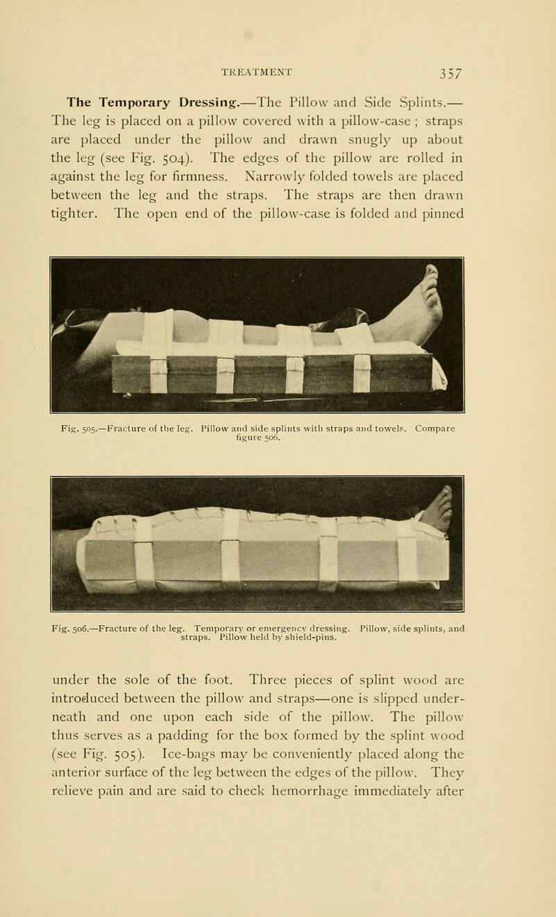 The Temporary Dressing.—The Pillow and Side Splints.— The leg is placed on a pillow covered with a pillow-case ; straps are placed under the pillow and drawn snugly up about the leg (see Fig. 504). The edges of the pillow are rolled in against the leg for firmness. Narrowly folded towels are placed between the leg and the straps. The straps are then drawn tighter. The open end of the pillow-case is folded and pinned Fig. 505.—Fracture of the leg. Pillow and side splints with straps and towels. Compare figure 506. Fig. 506.—Fracture of the leg. Temporary or emergency dressing. Pillow, side splints, and straps. Pillow held by shield-pins. under the sole of the foot. Three pieces of splint wood are introduced between the pillow and straps—one is slipped under- neath and one upon each side of the pillow. The pillow thus serves as a padding for the box formed by the splint wood (see Fig. 505). Ice-bags may be conveniently placed along the anterior surface of the leg between the edges of the pillow. They relieve pain and are said to check hemorrhage immediately after