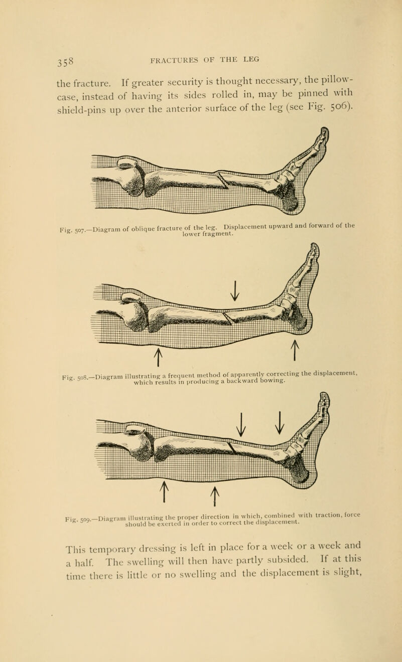 the fracture. If greater security is thought necessary, the pillow- case, instead of having its sides rolled in, may be pinned with shield-pins up over the anterior surface of the leg (see Fig. 506). Fie. soy.-Diagram of oblique fracture of the leg. Displacement upward and forward of the ower fragment. Fig soS -Diagram illustrating a frequent method of apparently correcting the displacement, 6' D which results in producing a backward bowing. Fie Soo.-Diagram illustrating the proper direction in which, combined with traction, force should be exerted in order to correct the displacement. This temporary dressing is left in place for a week or a week and a half. The swelling will then have partly subsided. If at this time there is little or no swelling and the displacement is slight,