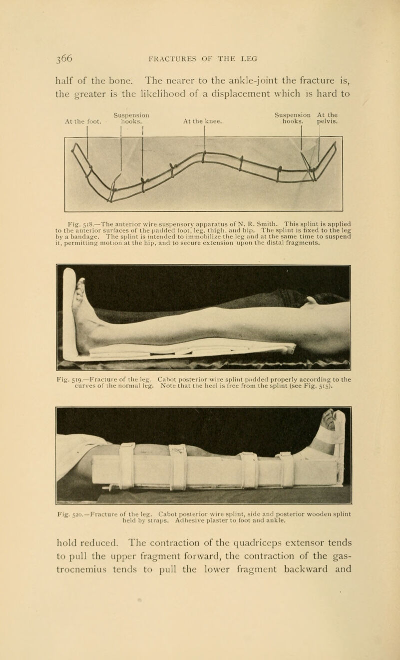 half of the bone. The nearer to the ankle-joint the fracture is, the greater is the likelihood of a displacement which is hard to At the foot Suspension At the hooks. pelvis. Fig. 518.—The anterior wire suspensory apparatus of N. R. Smith. This splint is applied to the anterior surfaces of the padded foot, leg, thigh, and hip. The splint is fixed to the leg by a bandage. The splint is intended to immobilize the leg and at the same time to suspend it, permitting motion at the hip, and to secure extension upon the distal fragments. !k »; Fig- 519-—Fracture of the leg. Cabot posterior wire splint padded properly according to the curves of the normal leg. Note that the heel is free from the splmt (see Fig. 515). Fig. 520.—Fracture of the leg. Cabot posterior wire splmt, m<1c- and posterior wooden splint held by snaps. Adhesive plaster to foot and ankle. hold reduced. The contraction of the quadriceps extensor tends to pull the upper fragment forward, the contraction of the gas- trocnemius tends to pull the lower fragment backward and