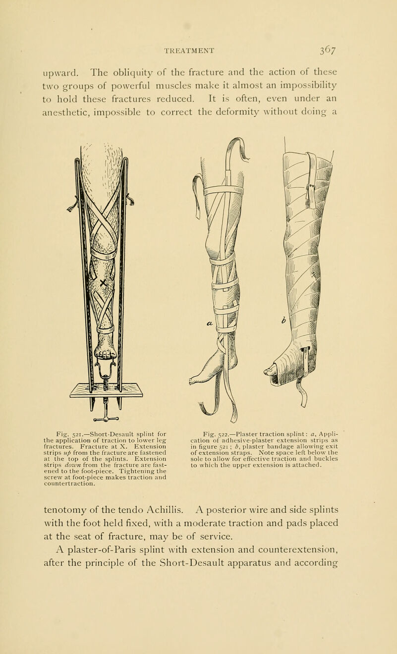 upward. The obliquity of the fracture and the action of these two groups of powerful muscles make it almost an impossibility to hold these fractures reduced. It is often, even under an anesthetic, impossible to correct the deformity without doing a Fig. 521.—Short-Desault splint for the application of traction to lower leg fractures. Fracture at X. Extension strips up from the fracture are fastened at the top of the splints. Extension strips down from the fracture are fast- ened to the foot-piece. Tightening the screw at foot-piece makes traction and countertraction. Fig. 522.—Plaster traction splint: a. Appli- cation of adhesive-plaster extension strips as in figure 521 ; d, plaster bandage allowing exit of extension straps. Note space left below the sole to allow for effective traction and buckles to which the upper extension is attached. tenotomy of the tendo Achillis. A posterior wire and side splints with the foot held fixed, with a moderate traction and pads placed at the seat of fracture, may be of service. A plaster-of-Paris splint with extension and counterextension, after the principle of the Short-Desault apparatus and according