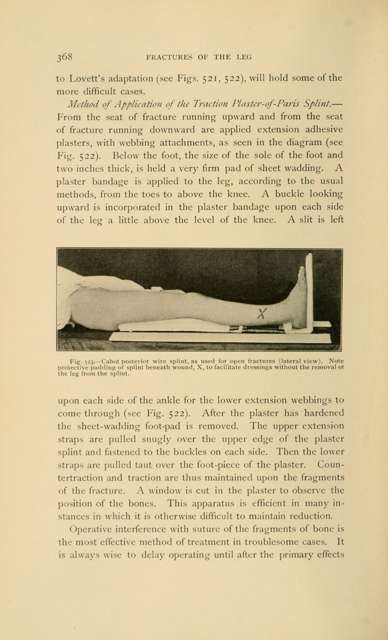 to Lovett's adaptation (see Figs. 521, 522), will hold some of the more difficult cases. Method of Application of the Traction Plaster-of-Paris Splint.— From the seat of fracture running upward and from the seat of fracture running downward are applied extension adhesive plasters, with webbing attachments, as seen in the diagram (see Fig. 522). Below the foot, the size of the sole of the foot and two inches thick, is held a very firm pad of sheet wadding. A plaster bandage is applied to the leg, according to the usual methods, from the toes to above the knee. A buckle looking upward is incorporated in the plaster bandage upon each side of the lee a little above the level of the knee. A slit is left Fig. 523.—Cabot posterior wire splint, as used for open fractures (lateral view). Note protective padding of splint beneath wound, X, to facilitate dressings without the removal ot the leg from the splint. upon each side of the ankle for the lower extension webbings to come through (see Fig. 522). After the plaster has hardened the sheet-wadding foot-pad is removed. The upper extension straps are pulled snugly over the upper edge of the plaster splint and fastened to the buckles on each side. Then the lower straps are pulled taut over the foot-piece of the plaster. Coun- tertraction and traction are thus maintained upon the fragments of the fracture. A window is cut in the plaster to observe the position of the bones. This apparatus is efficient in many in- stances in which it is otherwise difficult to maintain reduction. Operative interference with suture of the fragments of bone is the most effective method of treatment in troublesome cases. It is always wise to delay operating until after the primary effects