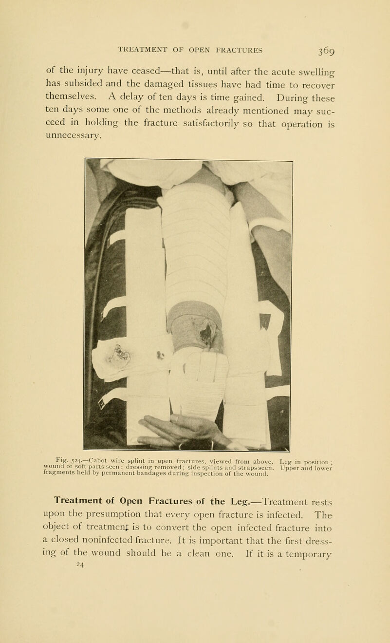 of the injury have ceased—that is, until after the acute swelling has subsided and the damaged tissues have had time to recover themselves. A delay often days is time gained. During these ten days some one of the methods already mentioned may suc- ceed in holding the fracture satisfactorily so that operation is unnecessary. Fig- 524.—Cabot wire splint in open fractures, viewed from above. Leg in position ; wound of soft parts seen ; dressing removed; side splints and straps seen. Upper and lower fragments held by permanent bandages during inspection of the wound. Treatment of Open Fractures of the Leg.—Treatment rests upon the presumption that every open fracture is infected. The object of treatment is to convert the open infected fracture into a closed noninfected fracture. It is important that the first dress- ing of the wound should be a clean one. If it is a temporary 24