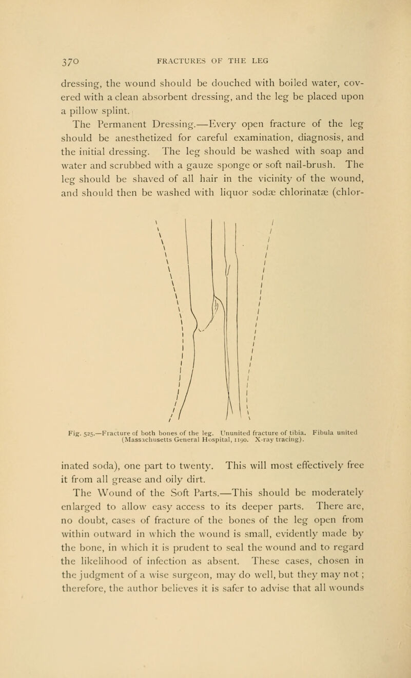 37Q dressing, the wound should be douched with boiled water, cov- ered with a clean absorbent dressing, and the leg be placed upon a pillow splint. The Permanent Dressing.—Every open fracture of the leg should be anesthetized for careful examination, diagnosis, and the initial dressing. The leg should be washed with soap and water and scrubbed with a gauze sponge or soft nail-brush. The leg should be shaved of all hair in the vicinity of the wound, and should then be washed with liquor sodse chlorinate (chlor- Fig. 525.—Fracture of both bones of the leg. Ununited fracture of tibia. Fibula united (Massachusetts General Hospital, nyo. X-ray tracing). inated soda), one part to twenty. This will most effectively free it from all grease and oily dirt. The Wound of the Soft Parts.—This should be moderately enlarged to allow easy access to its deeper parts. There are, no doubt, cases of fracture of the bones of the leg open from within outward in which the wound is small, evidently made by the bone, in which it is prudent to seal the wound and to regard the likelihood of infection as absent. These cases, chosen in the judgment of a wise surgeon, may do well, but they may not; therefore, the author believes it is safer to advise that all wounds