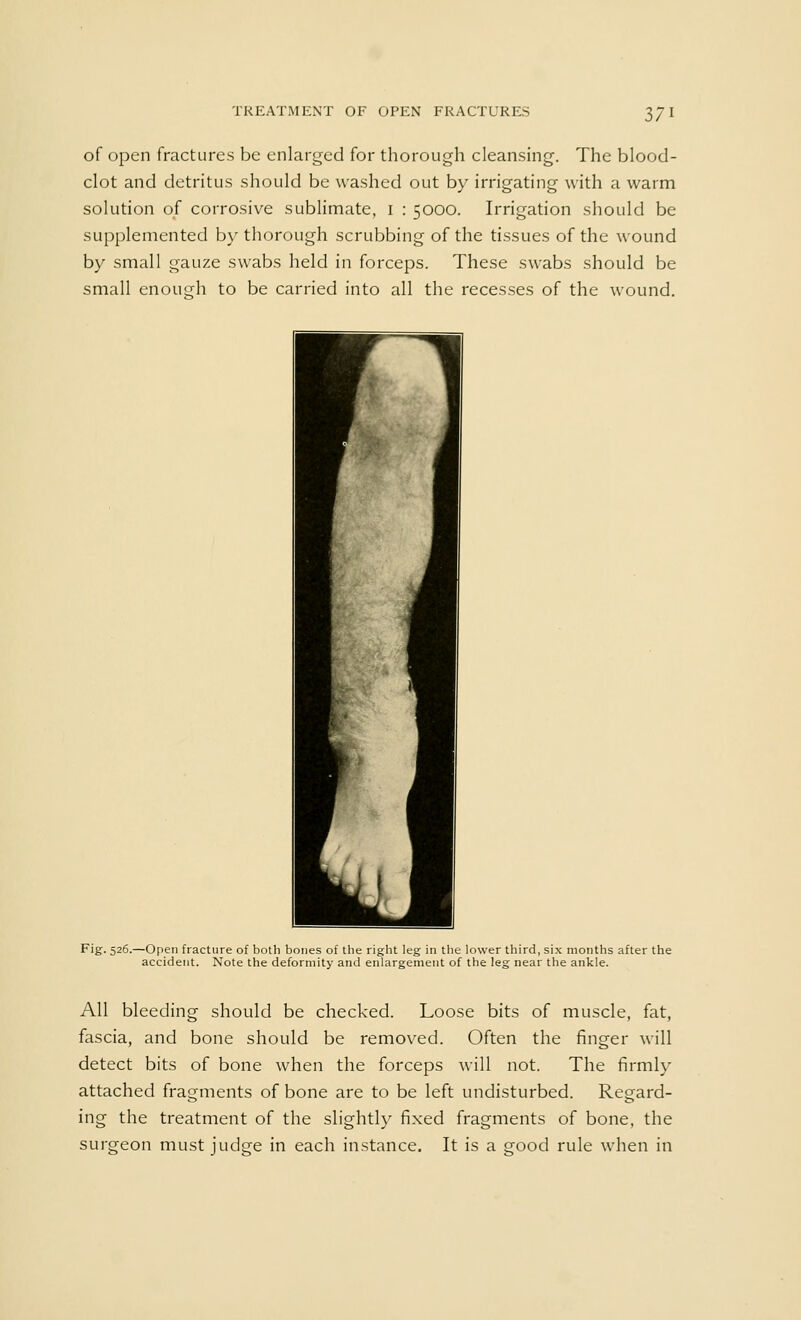 of open fractures be enlarged for thorough cleansing. The blood- clot and detritus should be washed out by irrigating with a warm solution of corrosive sublimate, 1 : 5000. Irrigation should be supplemented by thorough scrubbing of the tissues of the wound by small gauze swabs held in forceps. These swabs should be small enough to be carried into all the recesses of the wound. Fig. 526.—Open fracture of both bones of the right leg in the lower third, six months after the accident. Note the deformity and enlargement of the leg near the ankle. All bleeding should be checked. Loose bits of muscle, fat, fascia, and bone should be removed. Often the finger will detect bits of bone when the forceps will not. The firmly attached fragments of bone are to be left undisturbed. Regard- ing the treatment of the slightly fixed fragments of bone, the surgeon must judge in each instance. It is a good rule when in