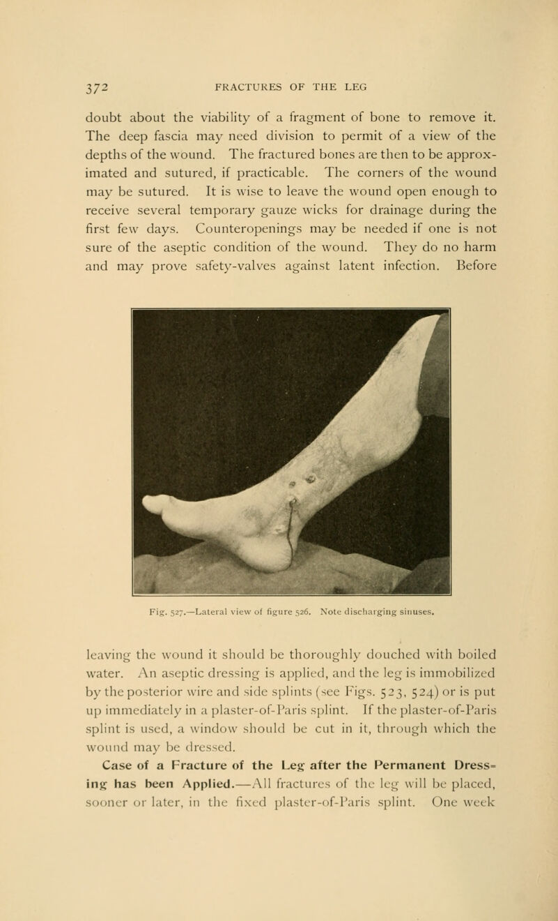 doubt about the viability of a fragment of bone to remove it. The deep fascia may need division to permit of a view of the depths of the wound. The fractured bones are then to be approx- imated and sutured, if practicable. The corners of the wound may be sutured. It is wise to leave the wound open enough to receive several temporary gauze wicks for drainage during the first few days. Counteropenings may be needed if one is not sure of the aseptic condition of the wound. They do no harm and may prove safety-valves against latent infection. Before Fig. 527.—Lateral view of figure 526. Note discharging sinuses. leaving the wound it should be thoroughly douched with boiled water. An aseptic dressing is applied, and the leg is immobilized by the posterior wire and side splints (see Figs. 523, 524) or is put up immediately in a plaster-of-Paris splint. If the plaster-of-Paris splint is used, a window should be cut in it, through which the wound may be dressed. Case of a Fracture of the Leg after the Permanent Dress= ing has heen Applied.—All fractures of the leg will be placed, sooner or later, in the fixed plaster-of-Paris splint. One week