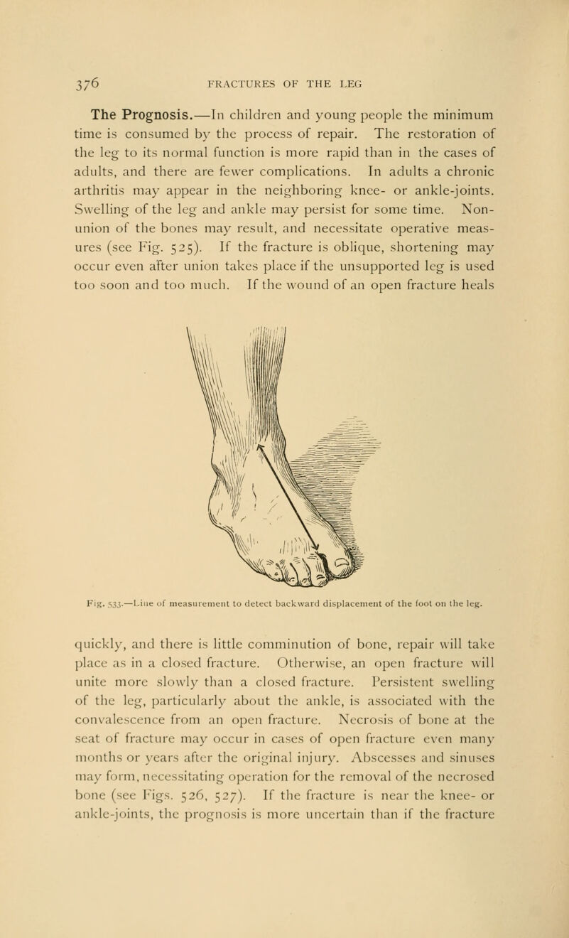 The Prognosis.—In children and young people the minimum time is consumed by the process of repair. The restoration of the leg to its normal function is more rapid than in the cases of adults, and there are fewer complications. In adults a chronic arthritis may appear in the neighboring knee- or ankle-joints. Swelling of the leg and ankle may persist for some time. Non- union of the bones may result, and necessitate operative meas- ures (see Fig. 525). If the fracture is oblique, shortening may occur even after union takes place if the unsupported leg is used too soon and too much. If the wound of an open fracture heals Fig. 531,.—Line of measurement to detect backward displacement of the foot on the leg. quickly, and there is little comminution of bone, repair will take place as in a closed fracture. Otherwise, an open fracture will unite more slowly than a closed fracture. Persistent swelling of the leg, particularly about the ankle, is associated with the convalescence from an open fracture. Necrosis of bone at the seat of fracture may occur in cases of open fracture even many months or years after the original injury. Abscesses and sinuses may form, necessitating operation for the removal of the necrosed bone (see Figs. 526, 527). If the fracture is near the knee- or ankle-joints, the prognosis is more uncertain than if the fracture