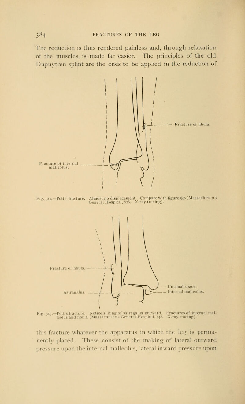 The reduction is thus rendered painless and, through relaxation of the muscles, is made far easier. The principles of the old Dupuytren splint are the ones to be applied in the reduction of L Fracture of fibula. Fracture of interna] malleolus. Fig. 542.—Pott's fracture. Almost no displacement. Compare with figure 540 (Massachusetts General Hospital, 828. X-ray tracing). Fracture of fibula. ■ Astragalus. — — Unusual space. — Internal malleolus. Fig. 543.—Pott's fracture. Notice sliding of astragalus outward. Fractures of internal ma] leolus and fibula (Massachusetts General Hospital, 548. X-ray tracing). this fracture whatever the apparatus in which the leg is perma- nently placed. These consist of tin- making of lateral outward pressure upon the internal malleolus, lateral inward pressure upon