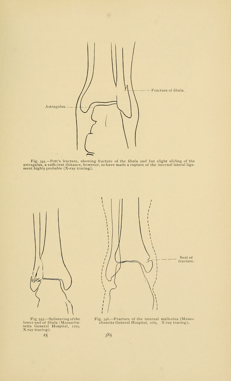 Astragalus — Fracture of fibula. Fig. 544.—Pott's fracture, showing fracture of the fibula and but slight sliding of the astragalus, a sufficient distance, however, to have made a rupture of the internal lateral liga- ment highly probable (X-ray tracing). Fig. 545.—Splintering of the lower end of fibula (Massachu- setts General Hospital, 1105. X-ray tracing). 25 Seat of fracture. Fig. 546.—Fracture of the internal malleolus (Massa- chusetts General Hospital, 10S4. X-ray tracing). 58S