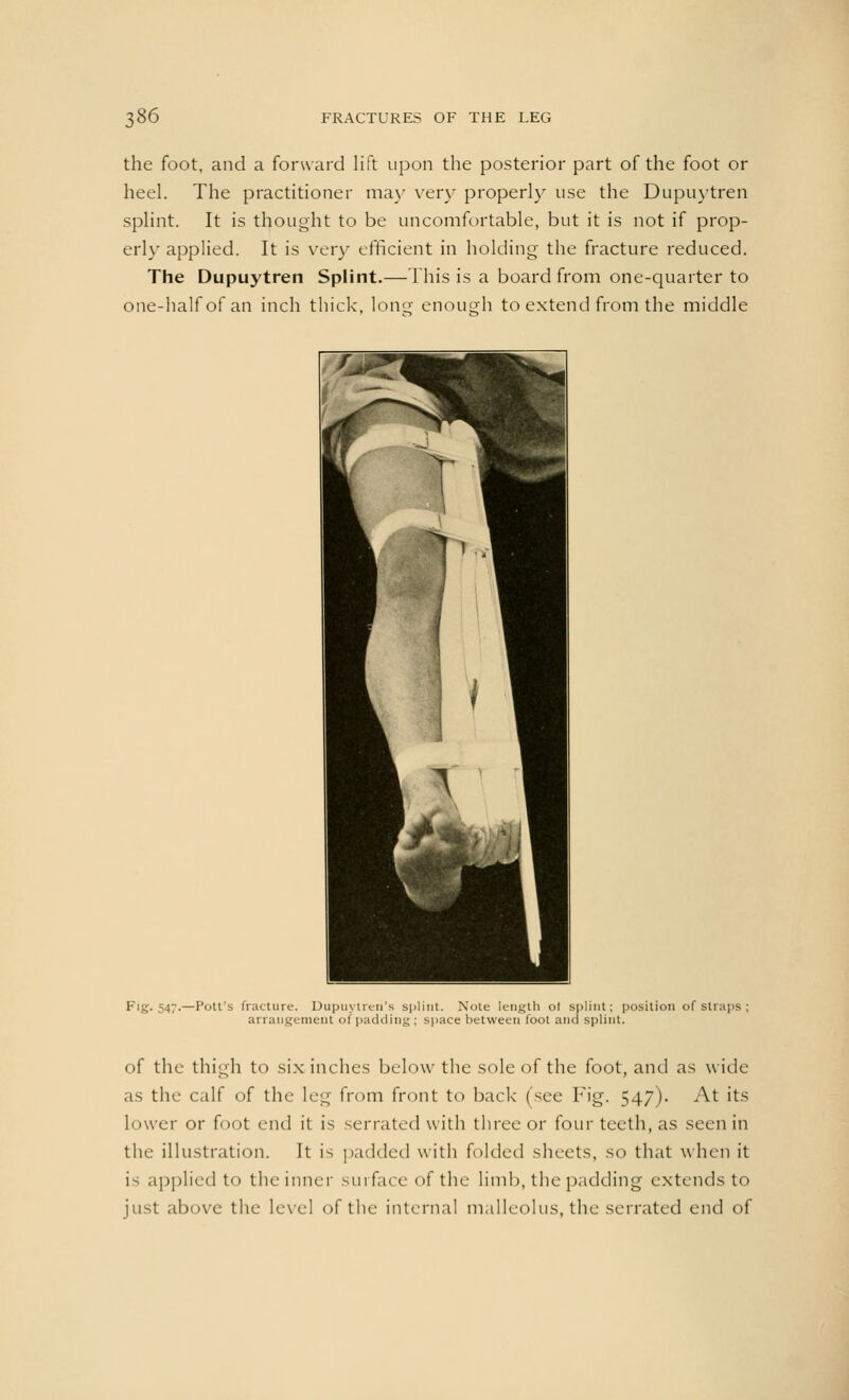 the foot, and a forward lift upon the posterior part of the foot or heel. The practitioner may very properly use the Dupuytren splint. It is thought to be uncomfortable, but it is not if prop- erly applied. It is very efficient in holding the fracture reduced. The Dupuytren Splint.— This is a board from one-quarter to one-half of an inch thick, long enough to extend from the middle Fig. 547.—Pott's fracture. Dupuytren's splint. Note length ol splint; position of straps arrangement <>i padding ; space between foot and splint. of the thigh to six inches below the sole of the foot, and as wide as the calf of the leg from front to back (see Fig. 547). At its lower or foot end it is serrated with three or four teeth, as seen in the illustration. It is padded with folded sheets, so that when it is applied to the inner surface of the limb, the padding extends to just above the level of the internal malleolus, the serrated end of