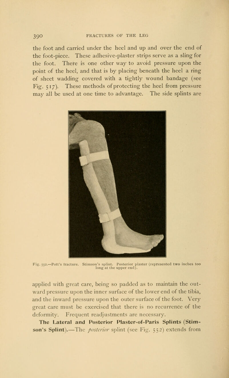 the foot and carried under the heel and up and over the end of the foot-piece. These adhesive-plaster strips serve as a sling for the foot. There is one other way to avoid pressure upon the point of the heel, and that is by placing beneath the heel a ring of sheet wadding covered with a tightly wound bandage (see Fig- Sl7)- These methods of protecting the heel from pressure may all be used at one time to advantage. The side splints are Fig. 552.—Pott's fracture. Stimsoti's splint. Posterior plaster (represented two inches too long at the upper end). applied with great care, being so padded as to maintain the out- ward pressure upon the inner surface of the lower end of the tibia, and the inward pressure upon the outer surface of the foot. Very great care must be exercised that there is no recurrence of the deformity. Frequent readjustments are necessary. The Lateral and Posterior Plaster=of=Paris Splints (Stim = son's Splint).—Tin: posterior splint (see Fig. 552) extends from