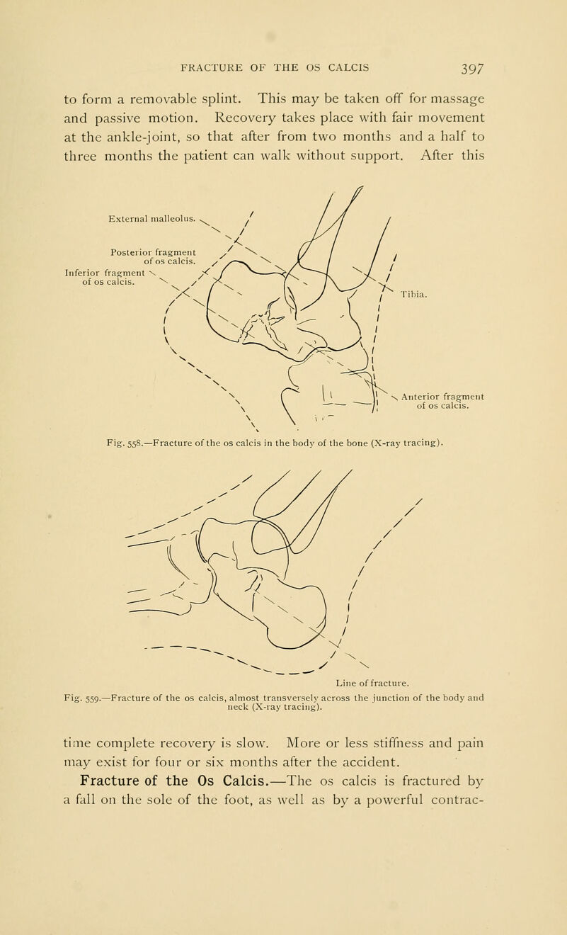 to form a removable splint. This may be taken off for massage and passive motion. Recovery takes place with fair movement at the ankle-joint, so that after from two months and a half to three months the patient can walk without support. After this External malleolus. Posterior fragment / of os calcis. y Inferior fragment v yC of os calcis. \ / / I I I v Tibia. , I li S Anterior fragment of os calcis. Fig. 558.—Fracture of the os calcis in the body of the bone (X-ray tracing). Line of fracture. Fig. 559.—Fracture of the os calcis, almost transversely across the junction of the body and neck (X-ray tracing). time complete recovery is slow. More or less stiffness and pain may exist for four or six months after the accident. Fracture of the Os Calcis.—The os calcis is fractured by a fall on the sole of the foot, as well as by a powerful contrac-