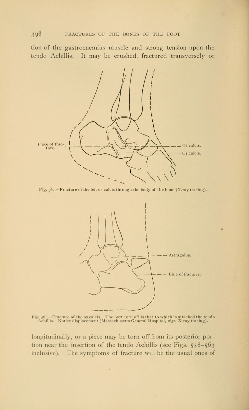 tion of the gastrocnemius muscle and strong tension upon the tendo Achillis. It may be crushed, fractured transversely or Place of frac- I ture. 1 Fig. 560.—Fracture of the left os calcis through the body of the bone (X-ray tracing). _i Astragalus. — Line of fracture. Fig. 5,61.—Fracture of the os calcis. The part torn oil is that to which is attached the tendo Achillis. Notice displacement (Massachusetts General Hospital, 1652. X-ray tracing). longitudinally, or a piece may be torn off from its posterior por- tion mar the insertion of the tendo Achillis (see Figs. 558—563 inclusive). The symptoms of fracture will be the usual ones of