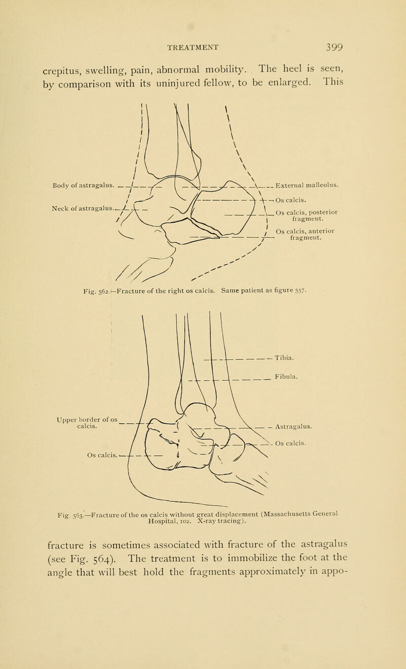 crepitus, swelling, pain, abnormal mobility. The heel is seen, by comparison with its uninjured fellow, to be enlarged. This Body of astragalus. 1 Neck of astragalus. ^J-\ / / External malleolus. ' -V -\—. Os calcis. _'i_Os calcis, posterior fragment. , Os calcis, anterior 7 fragment. Fig. 562.^Fracture of the right os calcis. Same patient as figure 557. Upper border ofos calcis. Os calcis. • Fig. 563.—Fracture of the os calcis without great displacement (Massachusetts General Hospital, 102. X-ray tracing). fracture is sometimes associated with fracture of the astragalus (see Fig. 564). The treatment is to immobilize the foot at the angle that will best hold the fragments approximately in appo-