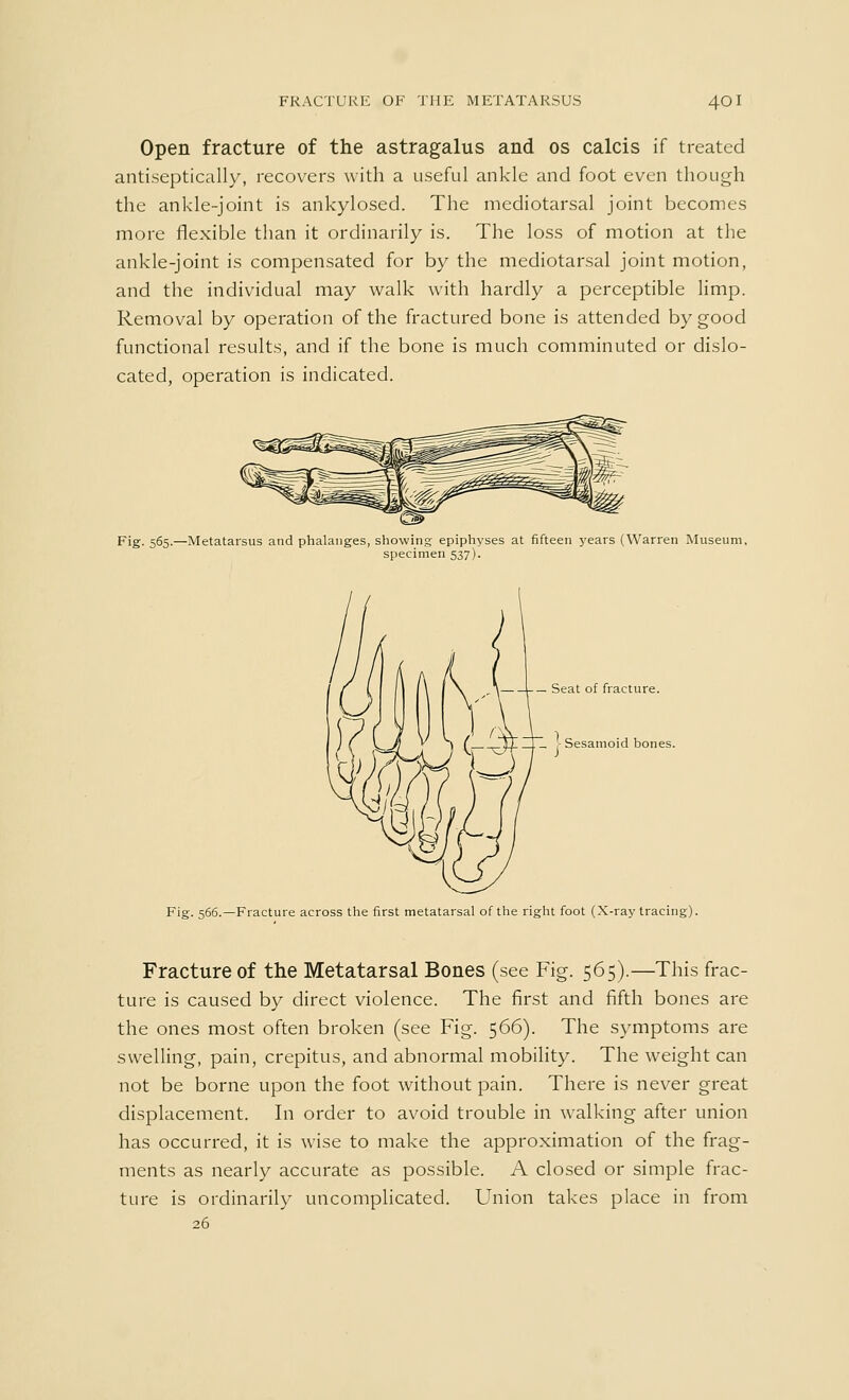 Open fracture of the astragalus and os calcis if treated antiseptically, recovers with a useful ankle and foot even though the ankle-joint is ankylosed. The mediotarsal joint becomes more flexible than it ordinarily is. The loss of motion at the ankle-joint is compensated for by the mediotarsal joint motion, and the individual may walk with hardly a perceptible limp. Removal by operation of the fractured bone is attended by good functional results, and if the bone is much comminuted or dislo- cated, operation is indicated. Fig. 565.—Metatarsus and phalanges, showing epiphyses at fifteen years (Warren Museum, specimen 537). Fig. 566.—Fracture across the first metatarsal of the right foot (X-ray tracing Fracture of the Metatarsal Bones (see Fig. 565).—This frac- ture is caused by direct violence. The first and fifth bones are the ones most often broken (see Fig. 566). The symptoms are swelling, pain, crepitus, and abnormal mobility. The weight can not be borne upon the foot without pain. There is never great displacement. In order to avoid trouble in walking after union has occurred, it is wise to make the approximation of the frag- ments as nearly accurate as possible. A closed or simple frac- ture is ordinarily uncomplicated. Union takes place in from 26