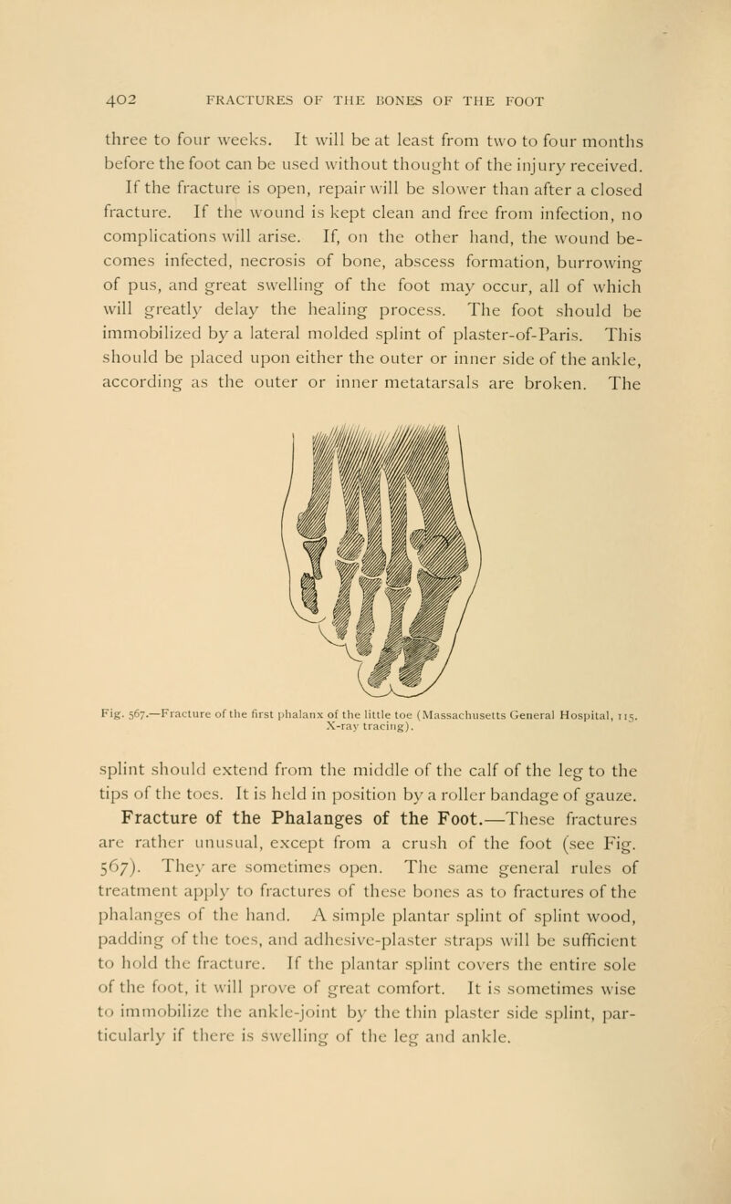 three to four weeks. It will be at least from two to four months before the foot can be used without thought of the injury received. If the fracture is open, repair will be slower than after a closed fracture. If the wound is kept clean and free from infection, no complications will arise. If, on the other hand, the wound be- comes infected, necrosis of bone, abscess formation, burrowing of pus, and great swelling of the foot may occur, all of which will greatly delay the healing process. The foot should be immobilized by a lateral molded splint of plaster-of-Paris. This should be placed upon either the outer or inner side of the ankle, according as the outer or inner metatarsals are broken. The Fig. 567.—Fracture of the first phalanx of the little toe (Massachusetts General Hospital, 115. X-ray tracing). splint should extend from the middle of the calf of the leg to the tips of the toes. It is held in position by a roller bandage of gauze. Fracture of the Phalanges of the Foot.—These fractures are rather unusual, except from a crush of the foot (see Fig. 567). They are sometimes open. The same general rules of treatment apply to fractures of these bones as to fractures of the phalanges of the hand. A simple plantar splint of splint wood, padding of the toes, and adhesive-plaster straps will be sufficient to hold the fracture. If the plantar splint covers the entire sole of the foot, it will prove of great comfort. It is sometimes wise to immobilize the ankle-joint by the thin plaster side splint, par- ticularly if there is swelling of the leg and ankle.