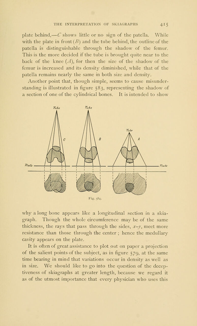 plate behind,—C shows little or no sign of the patella. While with the plate in front (B) and the tube behind, the outline of the patella is distinguishable through the shadow of the femur. This is the more decided if the tube is brought quite near to the back of the knee (A), for then the size of the shadow of the femur is increased and its density diminished, while that of the patella remains nearly the same in both size and density. Another point that, though simple, seems to cause misunder- standing is illustrated in figure 583, representing the shadow of a section of one of the cylindrical bones. It is intended to show TUte PLa.tt why a long bone appears like a longitudinal section in a skia- graph. Though the whole circumference may be of the same thickness, the rays that pass through the sides, x—v, meet more resistance than those through the center ; hence the medullar)7 cavity appears on the plate. It is often of great assistance to plot out on paper a projection of the salient points of the subject, as in figure 579, at the same time bearing in mind that variations occur in density as well as in size. We should like to go into the question of the decep- tiveness of skiagraphs at greater length, because we regard it as of the utmost importance that every physician who uses this