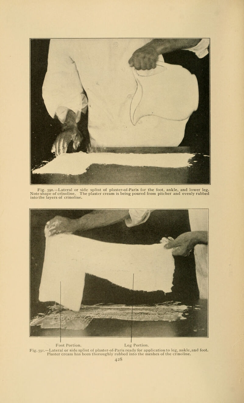 Fig. 590.—Lateral or side splint of plaster-of-Paris for the foot, ankle, and lower leg. Note shape of crinoline. The plaster cream is being poured from pitcher and evenly rubbed into the layers of crinoline. 1 oo1 Porl ion I I .it' ral 01 side splint ol plasti 1 of-Paris ready for application to leg, ankle, and foot. Plaster cream has been thoroughly rubbed into the meshes of the crinoline.
