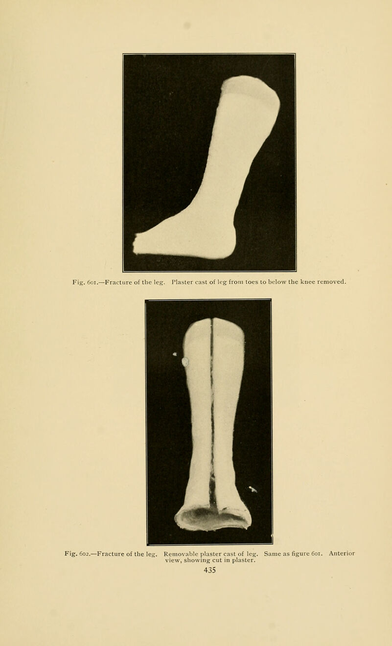 Fig. 601.—Fracture of the leg. Plaster cast of leg from toes to below the knee removed. Fig. 602.—Fracture of the leg. Removable plaster cast of leg. Same as figure 601. Anterior view, showing cut in plaster.