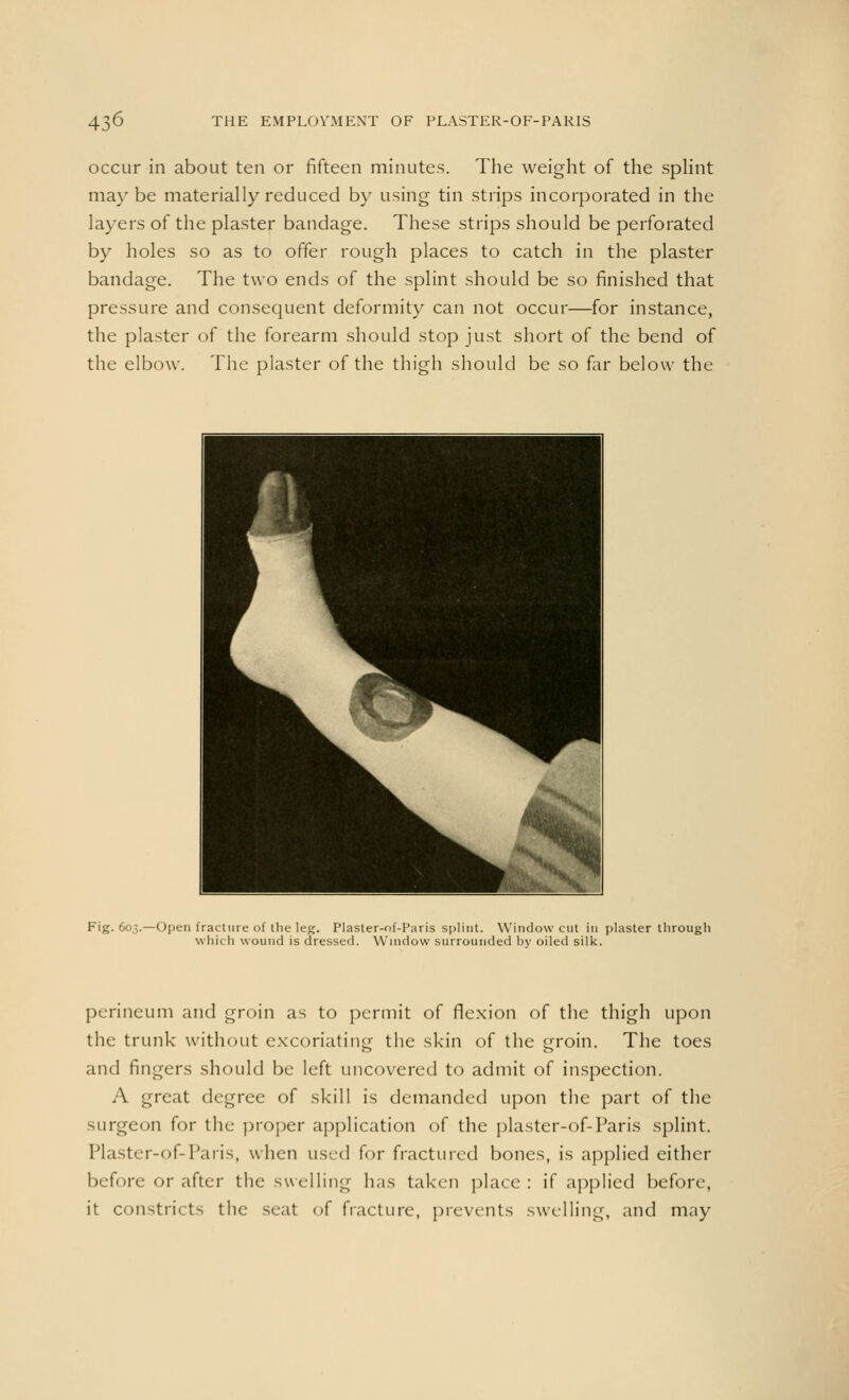 occur in about ten or fifteen minutes. The weight of the splint may be materially reduced by using tin strips incorporated in the layers of the plaster bandage. These strips should be perforated by holes so as to offer rough places to catch in the plaster bandage. The two ends of the splint should be so finished that pressure and consequent deformity can not occur—for instance, the plaster of the forearm should stop just short of the bend of the elbow. The plaster of the thigh should be so far below the Fig. 603.—Open fracture of the leg. Plaster-of-Paris splint. Window cut in plaster through which wound is dressed. Window surrounded by oiled silk. perineum and groin as to permit of flexion of the thigh upon the trunk without excoriating the skin of the groin. The toes and fingers should be left uncovered to admit of inspection. A great degree of skill is demanded upon the part of the surgeon for the proper application of the plaster-of-Paris splint. Plaster-of-Paris, when used for fractured bones, is applied either before or after the swelling has taken place : if applied before, it constricts the seat of fracture, prevents swelling, and may