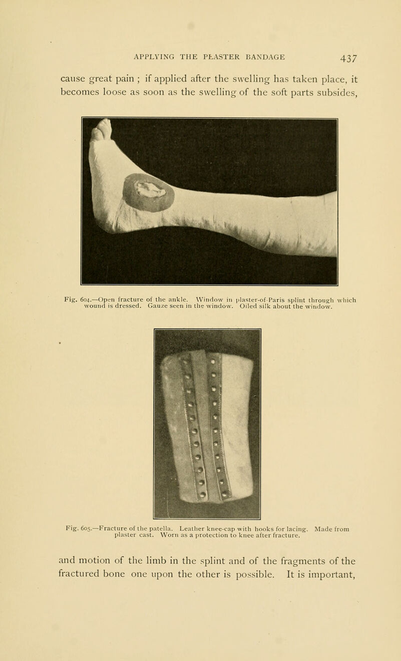 cause great pain ; if applied after the swelling has taken place, it becomes loose as soon as the swelling of the soft parts subsides, Fig. 604.—Open fracture of the ankle. Window in plaster-of-Paris splint through which wound is dressed. Gauze seen in the window. Oiled silk about the window. Fig. 605.—Fracture of the patella. Leather knee-cap with hooks for lacing. Made from plaster cast. Worn as a protection to knee after fracture. and motion of the limb in the splint and of the fragments of the fractured bone one upon the other is possible. It is important,