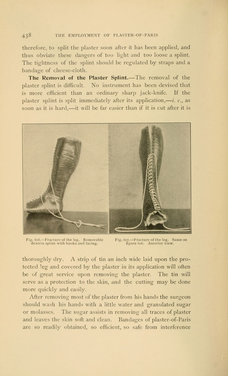 therefore, to split the plaster soon after it has been applied, and thus obviate these dangers of too light and too loose a splint. The tightness of the splint should be regulated by straps and a bandage of cheese-cloth. The Removal of the Plaster Splint.—The removal of the plaster splint is difficult. No instrument has been devised that is more efficient than an ordinary sharp jack-knife. If the plaster splint is split immediately after its application,—i. e., as soon as it is hard,—it will be far easier than if it is cut after it is Fig. 606.—Fracture of the leg. Removable dextrin splint with hooks and lacing. Fig. 607.—Fracture of the leg. Same as figure 606. Anterior view. thoroughly dry. A strip of tin an inch wide laid upon the pro- tected 'eg and covered by the plaster in its application will often be of great service upon removing the plaster. The tin will serve as a protection to the skin, and the cutting may be done more quickly and easily. After removing most of the plaster from his hands the surgeon should wash his hands with a little water and granulated sugar or molasses. The sugar assists in removing all traces of plaster and leaves the skin soft and clean. Bandages of plaster-of-Paris are so readily obtained, so efficient, so safe from interference