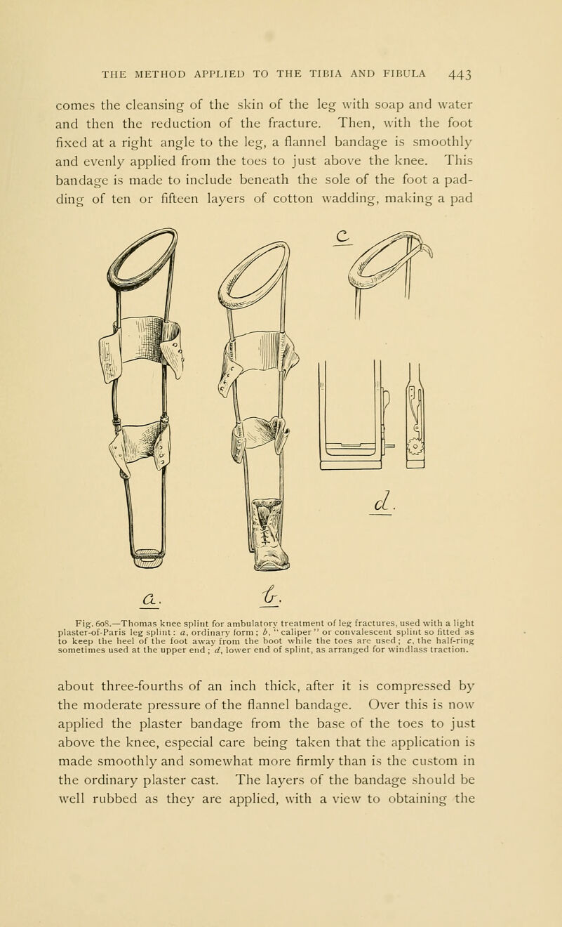 comes the cleansing of the skin of the leg with soap and water and then the reduction of the fracture. Then, with the foot fixed at a right angle to the leg, a flannel bandage is smoothly and evenly applied from the toes to just above the knee. This bandage is made to include beneath the sole of the foot a pad- ding of ten or fifteen layers of cotton wadding, making a pad a. £. Fig. 60S.—Thomas knee splint for ambulatory treatment of leg fractures, used with a light plaster-of-Paris leg splint: a, ordinary form ; 6,  caliper  or convalescent splint so fitted as to keep the heel of the foot away from the boot while the toes are used; c, the half-ring sometimes used at the upper end ;'d, lower end of splint, as arranged for windlass traction. about three-fourths of an inch thick, after it is compressed by the moderate pressure of the flannel bandage. Over this is now applied the plaster bandage from the base of the toes to just above the knee, especial care being taken that the application is made smoothly and somewhat more firmly than is the custom in the ordinary plaster cast. The layers of the bandage should be well rubbed as they are applied, with a view to obtaining the