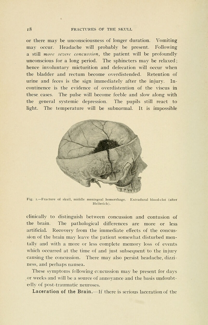 or there may be unconsciousness of longer duration. Vomiting may occur. Headache will probably be present. Following a still THore severe concussion, the patient will be profoundly unconscious for a long period. The sphincters may be relaxed; hence involuntary micturition and defecation will occur when the bladder and rectum become overdistended. Retention of urine and feces is the sign immediately after the injury. In- continence is the evidence of overdistention of the viscus in these cases. The pulse will become feeble and slow along with the general systemic depression. The pupils still react to light. The temperature will be subnormal. It is impossible Fig. I.—Fracture of skull, middle meningeal hemorrhage. Extradural blood-clot (after Helferich). clinically to distinguish between concussion and contusion of the brain. The pathological differences are more or less artificial. Recovery from the immediate effects of the concus- sion of the brain may leave the patient somewhat disturbed men- tally and with a more or less complete memory loss of events which occurred at the time of and just subsequent to the injury causing the concussion. There may also persist headache, dizzi- ness, and perhaps nausea. These symptoms following concussion may be present for days or weeks and will be a source of annoyance and the basis undoubt- edly of post-traumatic neuroses. Laceration of the Brain.—If there is serious laceration of the