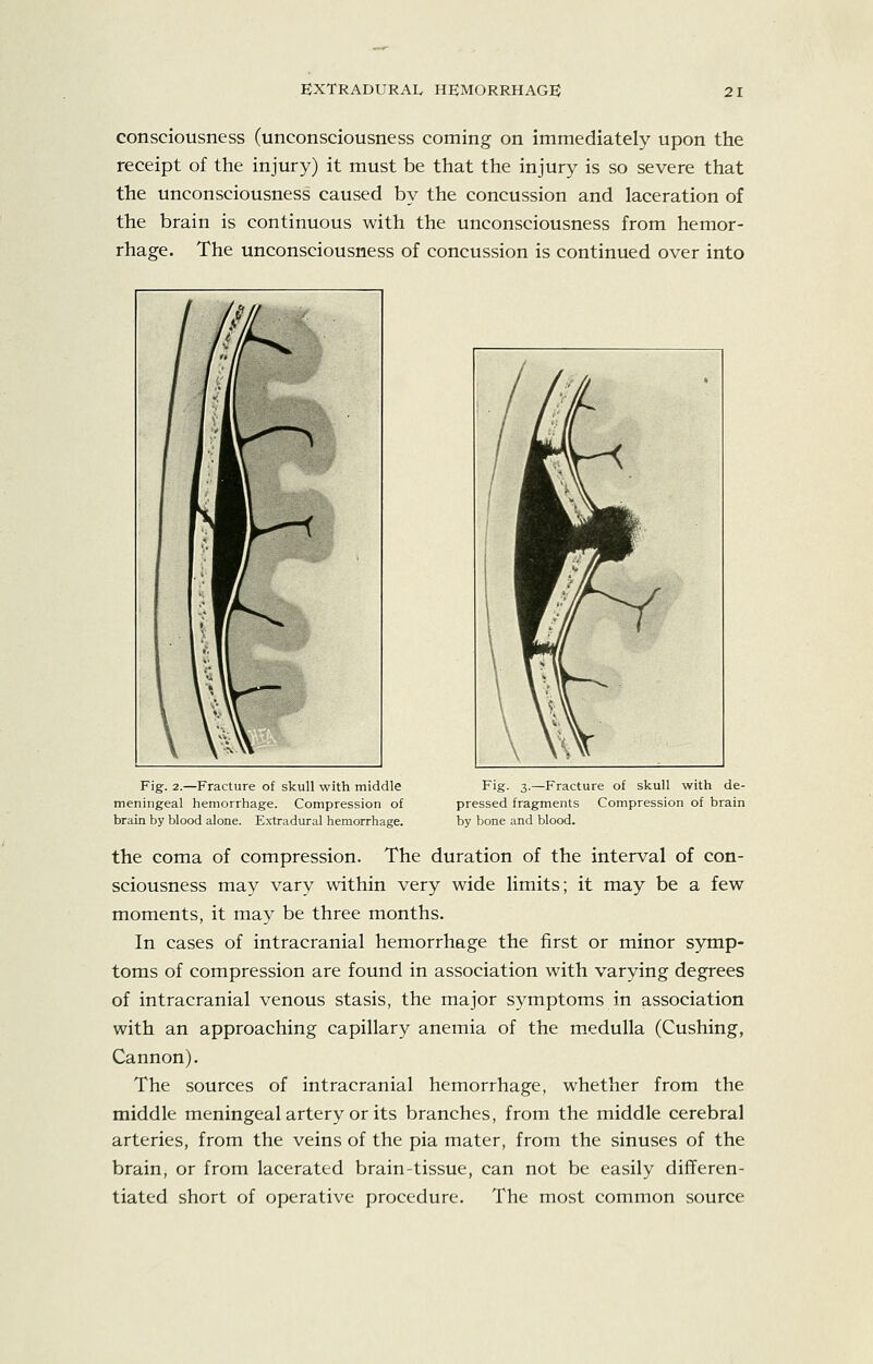 consciousness (unconsciousness coming on immediately upon the receipt of the injury) it must be that the injury is so severe that the unconsciousness caused by the concussion and laceration of the brain is continuous with the unconsciousness from hemor- rhage. The unconsciousness of concussion is continued over into Fig. 2.—Fracture of skull with middle meningeal hemorrhage. Compression of brain by blood alone. Extradural hemorrhage. Fig. 3.—Fracture of skull with de- pressed fragments Compression of brain by bone and blood. the coma of compression. The duration of the interval of con- sciousness may vary within very wide limits; it may be a few moments, it may be three months. In cases of intracranial hemorrhage the first or minor symp- toms of compression are found in association with varying degrees of intracranial venous stasis, the major symptoms in association with an approaching capillary anemia of the medulla (Gushing, Cannon). The sources of intracranial hemorrhage, whether from the middle meningeal artery or its branches, from the middle cerebral arteries, from the veins of the pia mater, from the sinuses of the brain, or from lacerated brain-tissue, can not be easily differen- tiated short of operative procedure. The most common source