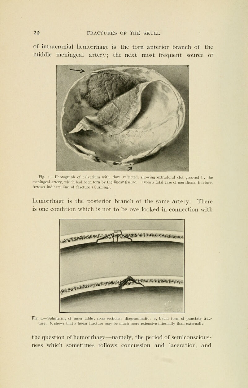 of intracranial hemorrhage is the torn anterior branch of the middle meningeal artery; the next most frequent source of Fig. 4.—Photograph of calvarium with tliira rcilccterl, showing extradural clot grooved by the meningeal artery, which had been torn by the linear assure. 1-rom a fatal case of meridional fracture. Arrows indicate line of fracture (Gushing). hemorrhage is the posterior branch of the same artery, There is one condition which is not to be overlooked in connection with ^tf*** •» ♦•'*^'^^^«N*(M Fig. 5.—Splintering of inner table; cross-sections ; diagrammatic : a, Usual form of punctate frac- ture ; 6, shows that a linear fracture may be much more extensive internally than externally. the question of hemorrhage—namely, the period of semiconscious- ness which sometimes follows concussion and laceration, and
