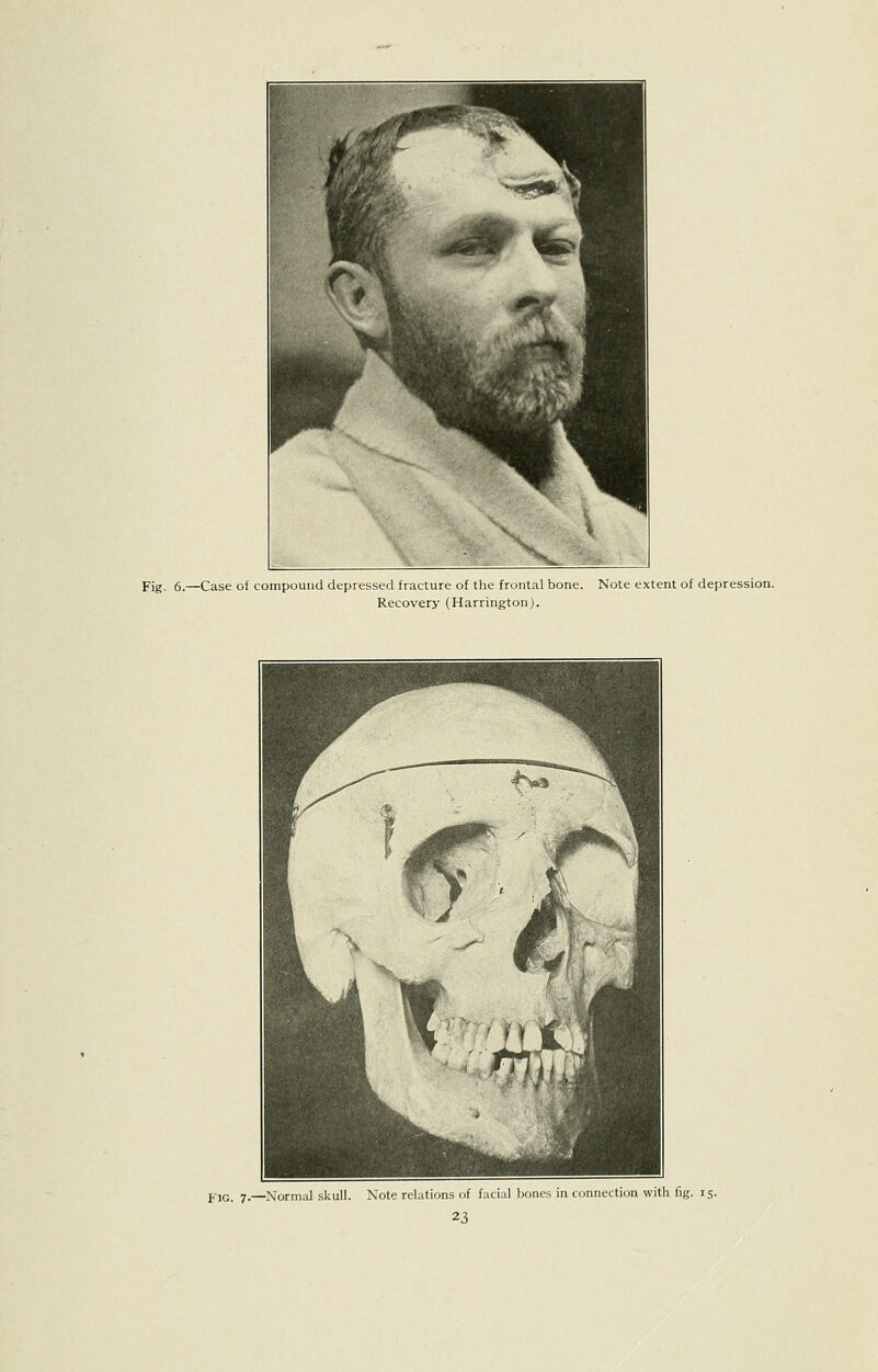 Fig. 6.—Case of compound depressed fracture of the frontal bone. Note extent of depression. Recovery (Harrington). j,-,g_ y_—Normal skull. Note relations of fuciul bones in connection with fig. 15.