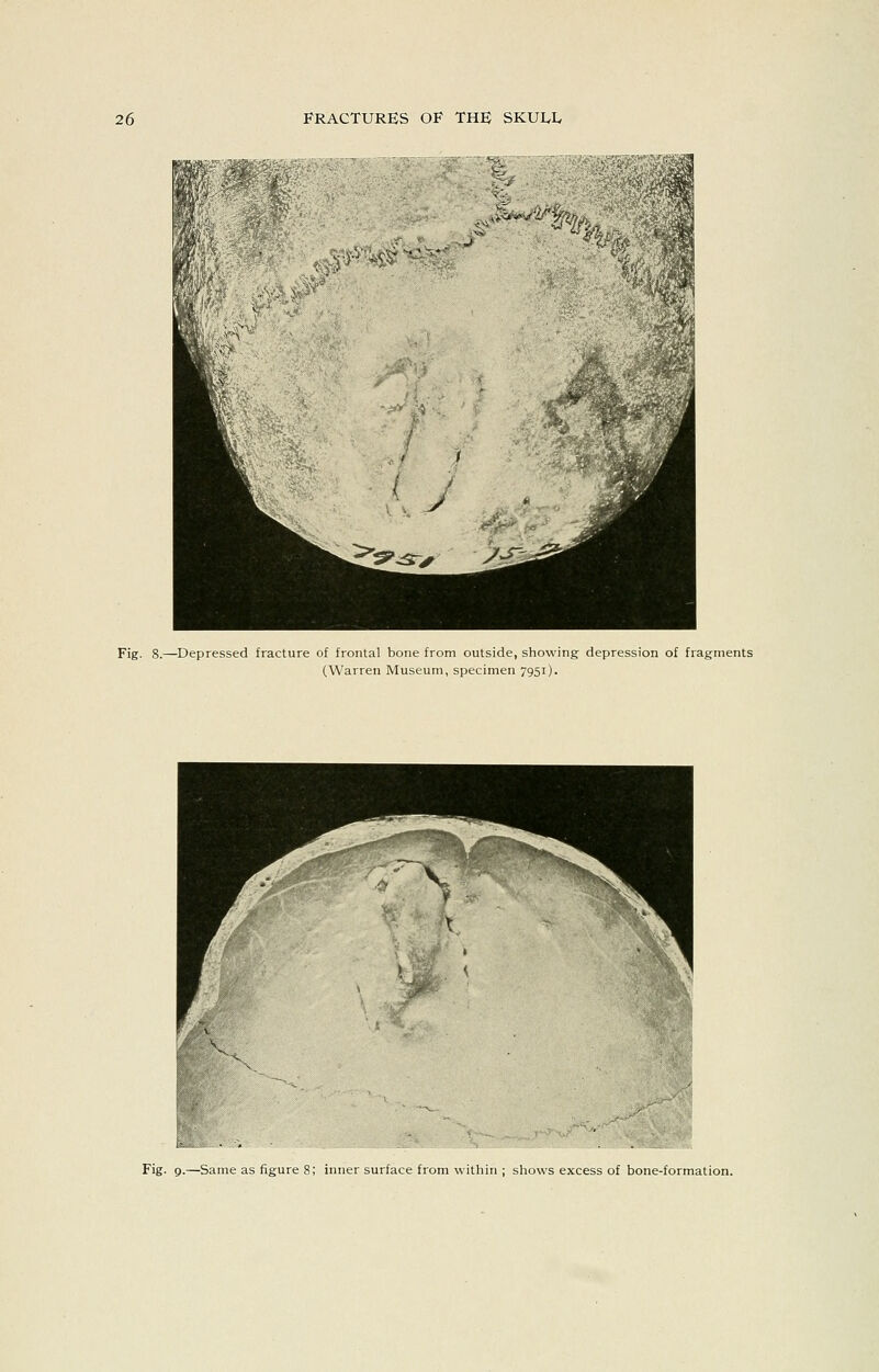 Fig. 8.—Depressed fracture of frontal bone from outside, showing depression of fragments (Warren Museum, specimen 7951). Fig. 9.—Same as figure 8; inner surface from within ; shows excess of bone-formation.
