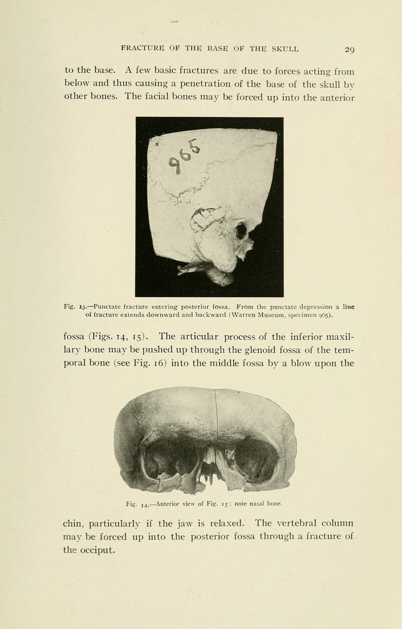 fracture; of the; base; of the; skull to the base. A few basic fractures are due to forces acting from below and thus causing a penetration of the base of the skull by other bones. The facial bones may be forced up into the anterior Fig. 13.—Punctate fracture entering posterior fossa. From the punctate depression a line of fracture extends downward and backward (Warren Museum, specimen 965). fossa (Figs. 14, 15). The articular process of the inferior maxil- lary bone may be pushed up through the glenoid fossa of the tem- poral bone (see Fig. i6) into the middle fossa by a blow upon the Fig- 14.—Anterior view of Fig. 15 ; note nasal bone. chin, particularly if the jaw is relaxed. The vertebral column may be forced up into the posterior fossa through a fracture of the occiput.