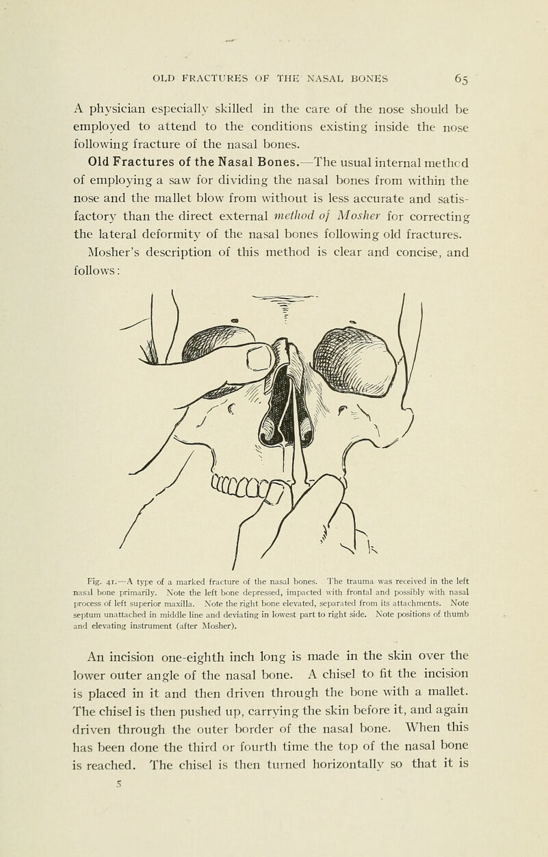 A physician especially skilled in the care of the nose should be employed to attend to the conditions existing inside the nose following fracture of the nasal bones. Old Fractures of the Nasal Bones.—The usual internal method of employing a saw for dividing the nasal bones from within the nose and the mallet blow from without is less accurate and satis- factor}^ than the direct external method of Mosher for correcting the lateral deformity of the nasal bones following old fractures. Mosher's description of this method is clear and concise, and follows: Fig. 41.—A type of a marked fracture of the nasal bones. The trauma was received in the left nasal bone primarily. Note the left bone depressed, impacted with frontal and possibly with nasal process of left superior maxilla. Note the right bone elevated, separated from its attachments. Note septum unattached in middle line and deviating in lowest part to right side. Note positions of thumb and elevating instrument (after Mosher). An incision one-eighth inch long is made in the skin over the lower outer angle of the nasal bone. A chisel to fit the incision is placed in it and then driven through the bone with a mallet. The chisel is then pushed up, carrying the skin before it, and again driven through the outer border of the nasal bone. When this has been done the third or fourth time the top of the nasal bone is reached. The chisel is then turned horizontally so that it is 5