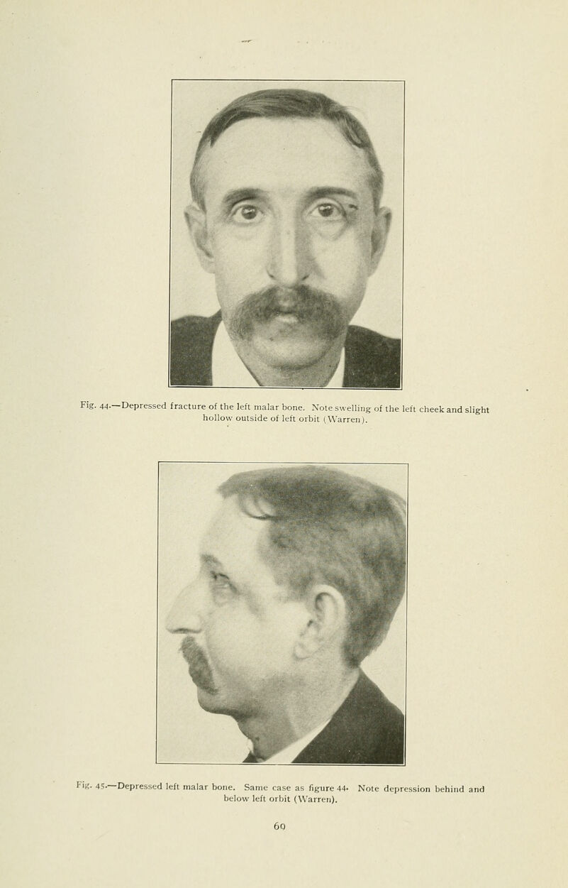 Fig. 44-—Depressed fracture of the left malar bone. Note swelling of the left cheek and slight hollow outside of left orbit (Warren). Fi«- 45.—Depressed left malar bone. Same case as figure 44- Note depression behind and below left orbit (Warren). 60