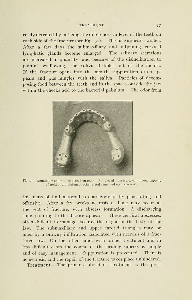 easily detected by noticing the differences in level of the teeth on each side of the fracture (see Fig. 52J. The face appears swollen. After a few days the submaxillary and adjoining cervical lymphatic glands become enlarged. The salivary secretions are increased in quantity, and because of the disinclination to painful swallowing, the saliva dribbles out of the mouth. If the fracture opens into the mouth, suppuration often ap- pears and pus mingles with the saliva. Particles of decom- posing food between the teeth and in the spaces outside the jaw within the cheeks add to the bacterial pabulum. The odor from Fig. 53-—Aluminium splint to be placed on teeth. For closed fracture, a continuous capping of gold or aluminium or other metal cemented upon the teeth. this mass of foul material is characteristically penetrating and offensive. After a few weeks necrosis of bone may occur at the seat of fracture, with abscess formation. A discharging sinus pointing to the disease appears. These cervical abscesses, often difficult to manage, occupy the region of the body of the jaw. The submaxillary and upper carotid triangles may be filled by a brawny infiltration associated with necrosis of a frac- tured jaw. On the other hand, with proper treatment and in less difficult cases the course of the healing process is simple and of easy management. Suppuration is prevented. There is no necrosis, and the repair of the fracture takes place unhindered. Treatment.—The primary object of treatment is the pres-