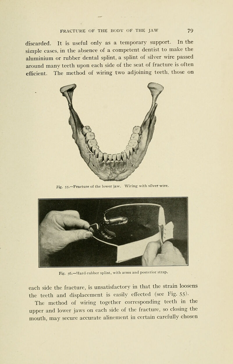 discarded. It is useful only as a temporary support. In the simple cases, in the absence of a competent dentist to make the aluminium or rubber dental splint, a splint of silver wire passed around many teeth upon each side of the seat of fracture is often efficient. The method of wiring two adjoining teeth, those on |^T*yc# 'f Fig. 55.—Fracture of the lower jaw. Wiring with silver wire. Pig. 56.—Hard-rubber splint, with arms and posterior strap. each side the fracture, is unsatisfactory in that the strain loosens the teeth and displacement is easily effected (see Fig. 55)- The method of wiring together corresponding teeth in the upper and lower jaws on each side of the fracture, so closing the mouth, may secure accurate alinement in certain carefully chosen
