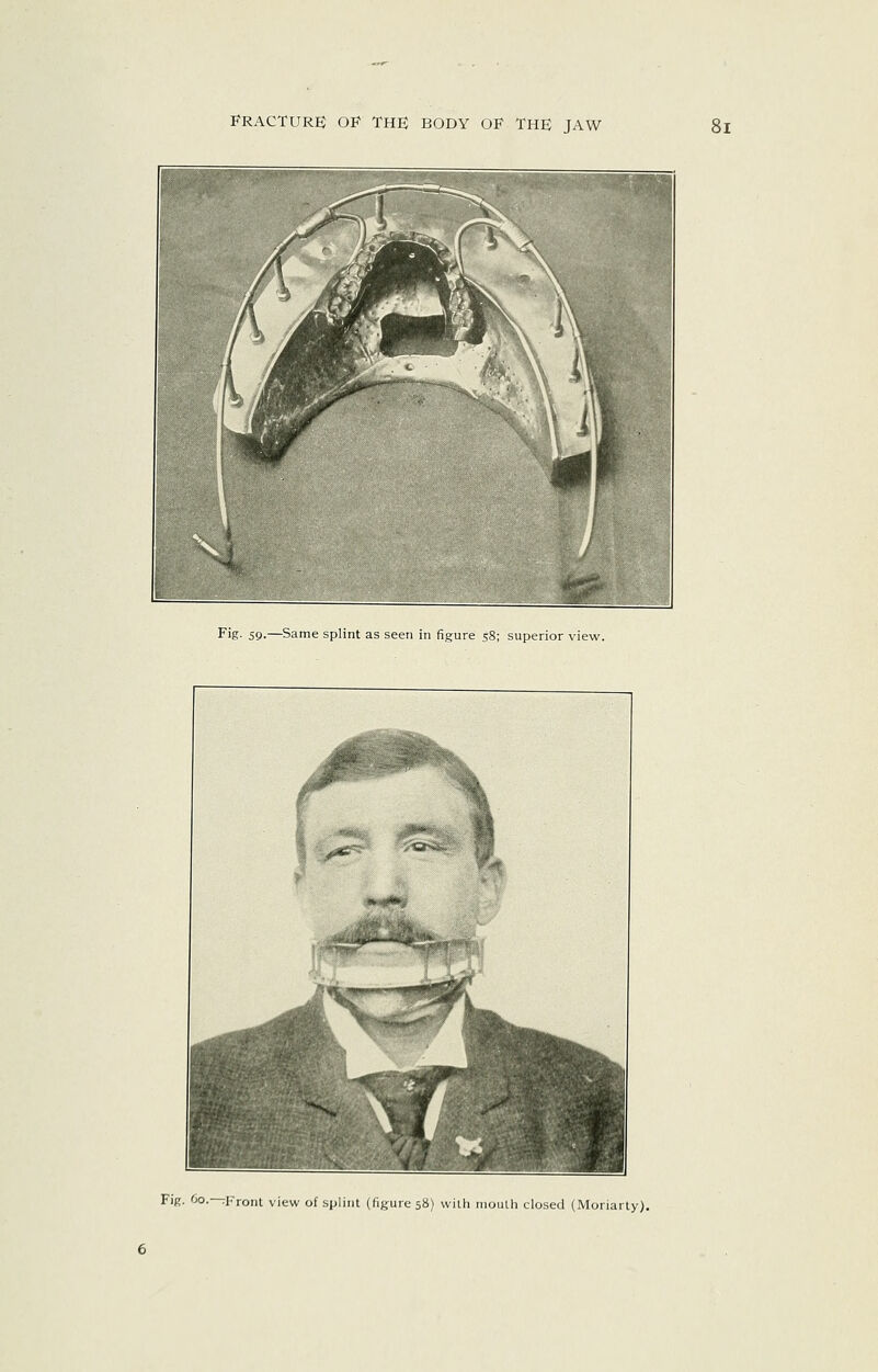 Fig- 59-—Same splint as seen in figure 58; superior view. FiR. Oo. .Front view of splint (figure 58) with mouth closed (Moriarty).
