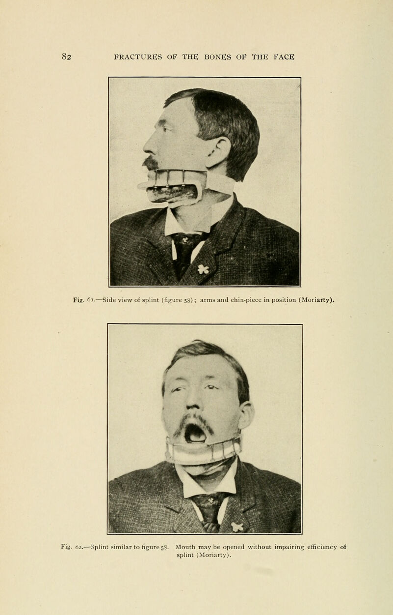Fig. 6i.—Side view of splint (figure ss); arms and chin-piece in position (Moriarty). f. -N f- ^ 1 1^^^^ «fe Fig. 62.—Splint similar to figure 58. Mouth maybe opened without impairing efficiency of splint (Moriarty).